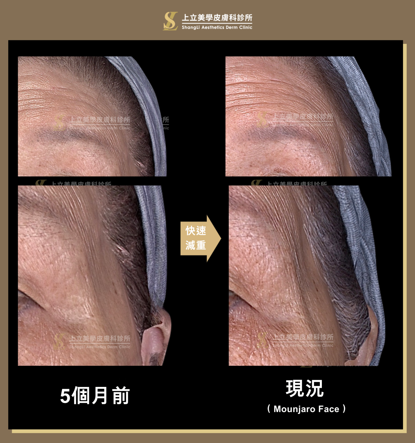 上半臉也有相似情形，額頭上的紋路變長、變深，夫妻宮也有更明顯凹陷痕跡。