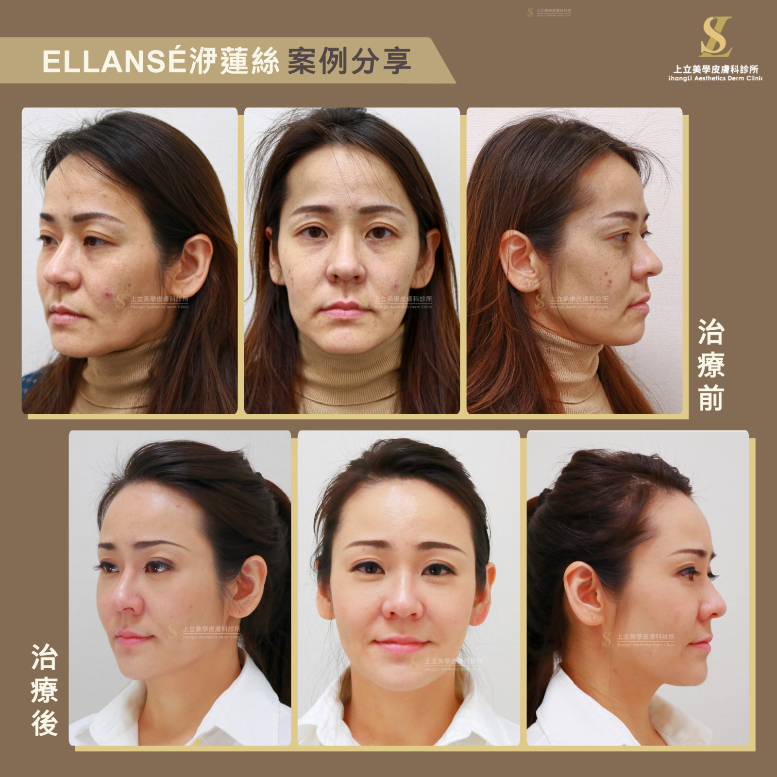 洢蓮絲則是目前唯一的凝膠劑型膠原蛋白增生劑