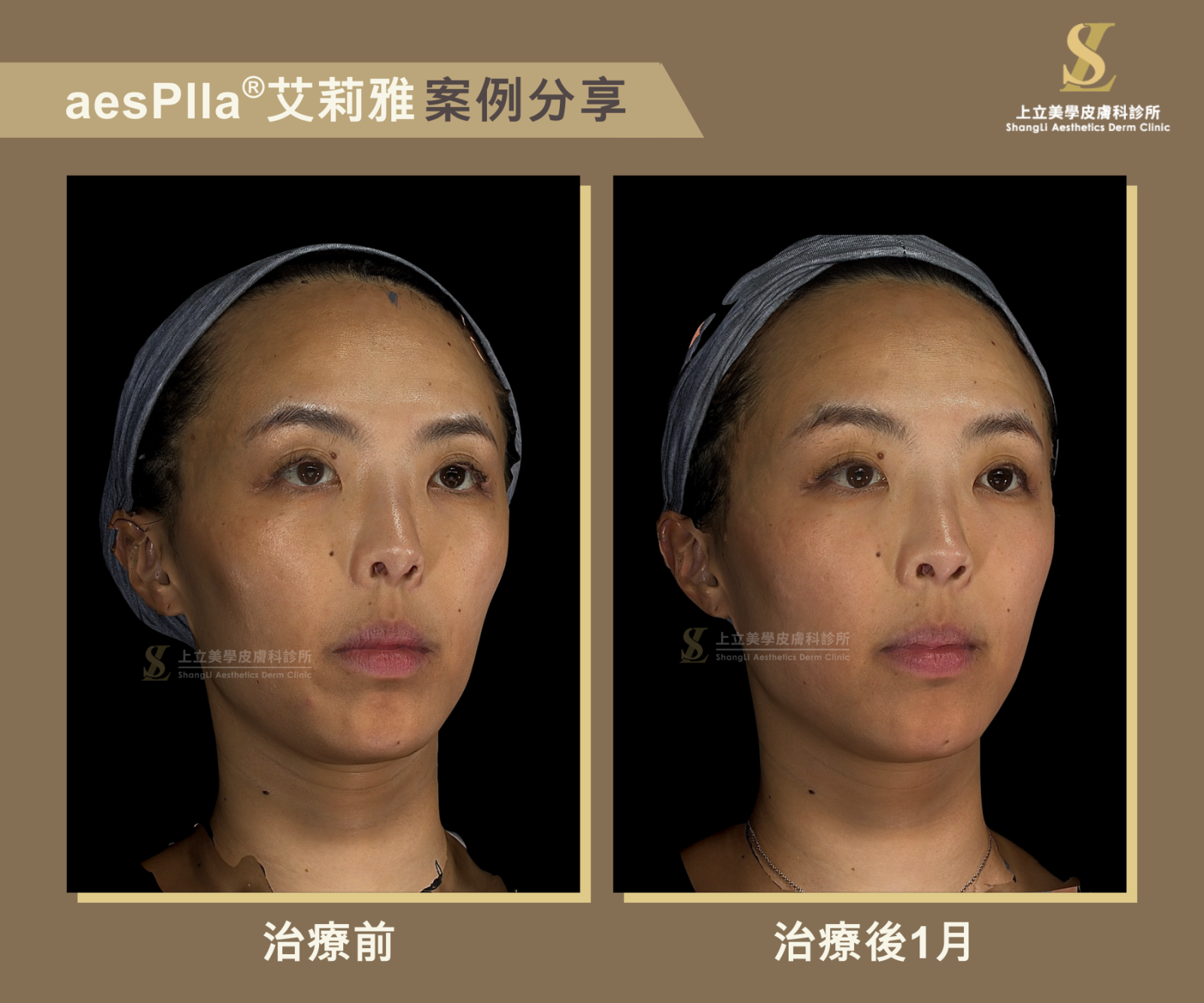 aesPlla&reg;艾莉雅和4D童妍針