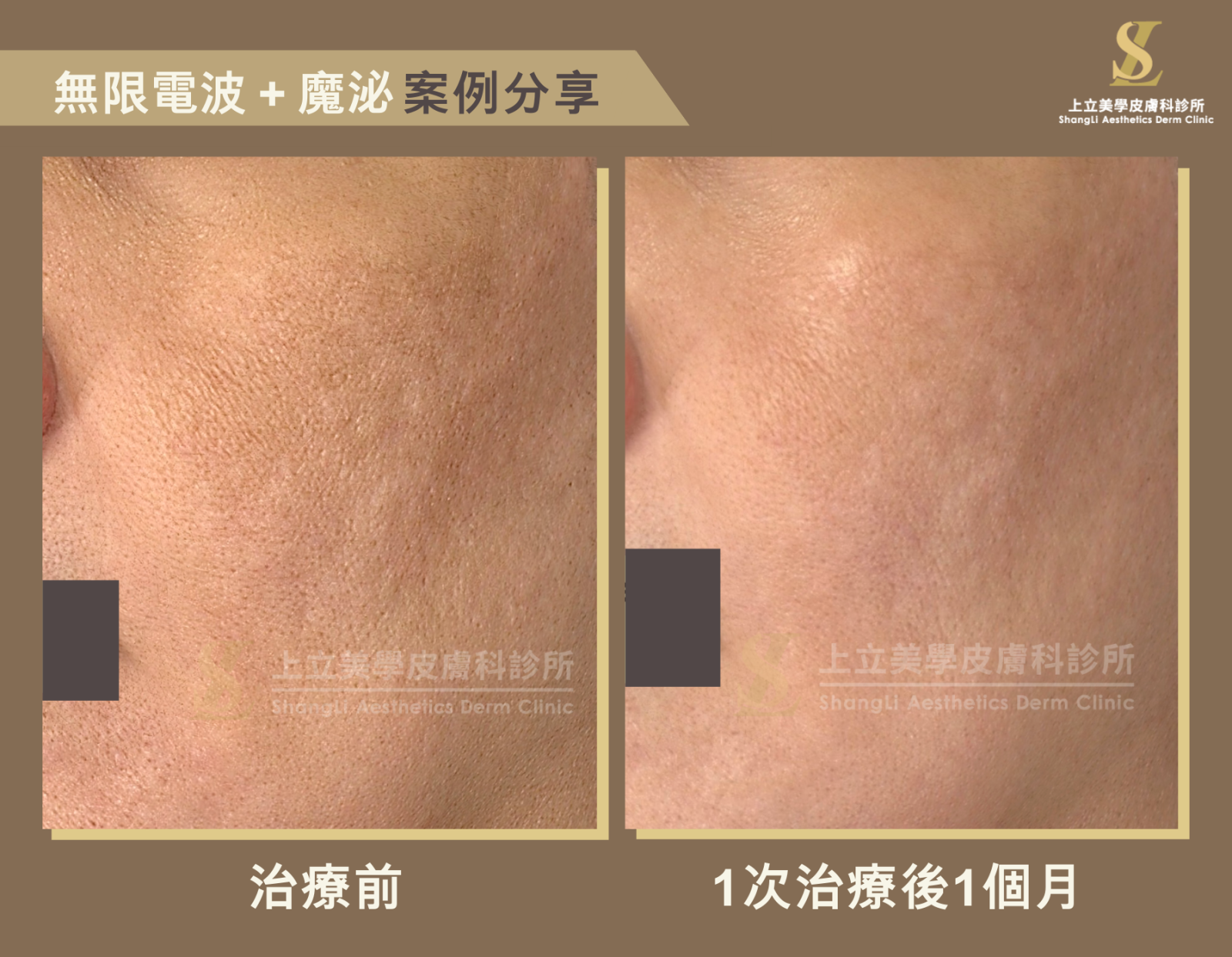 Potenza無限電波搭配魔泌，針對膚質改善有很好的效果。