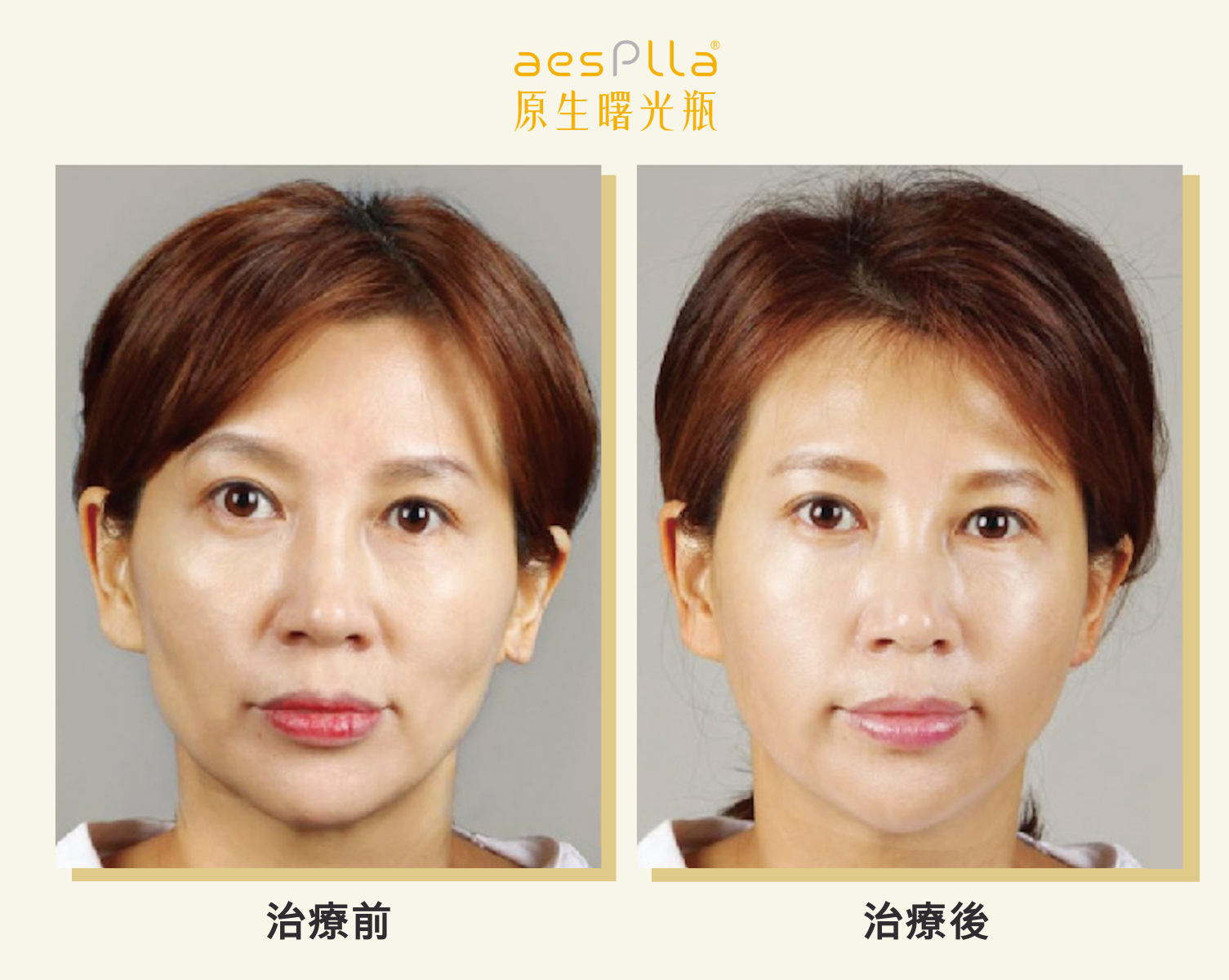 aesPlla&reg;艾莉雅案例