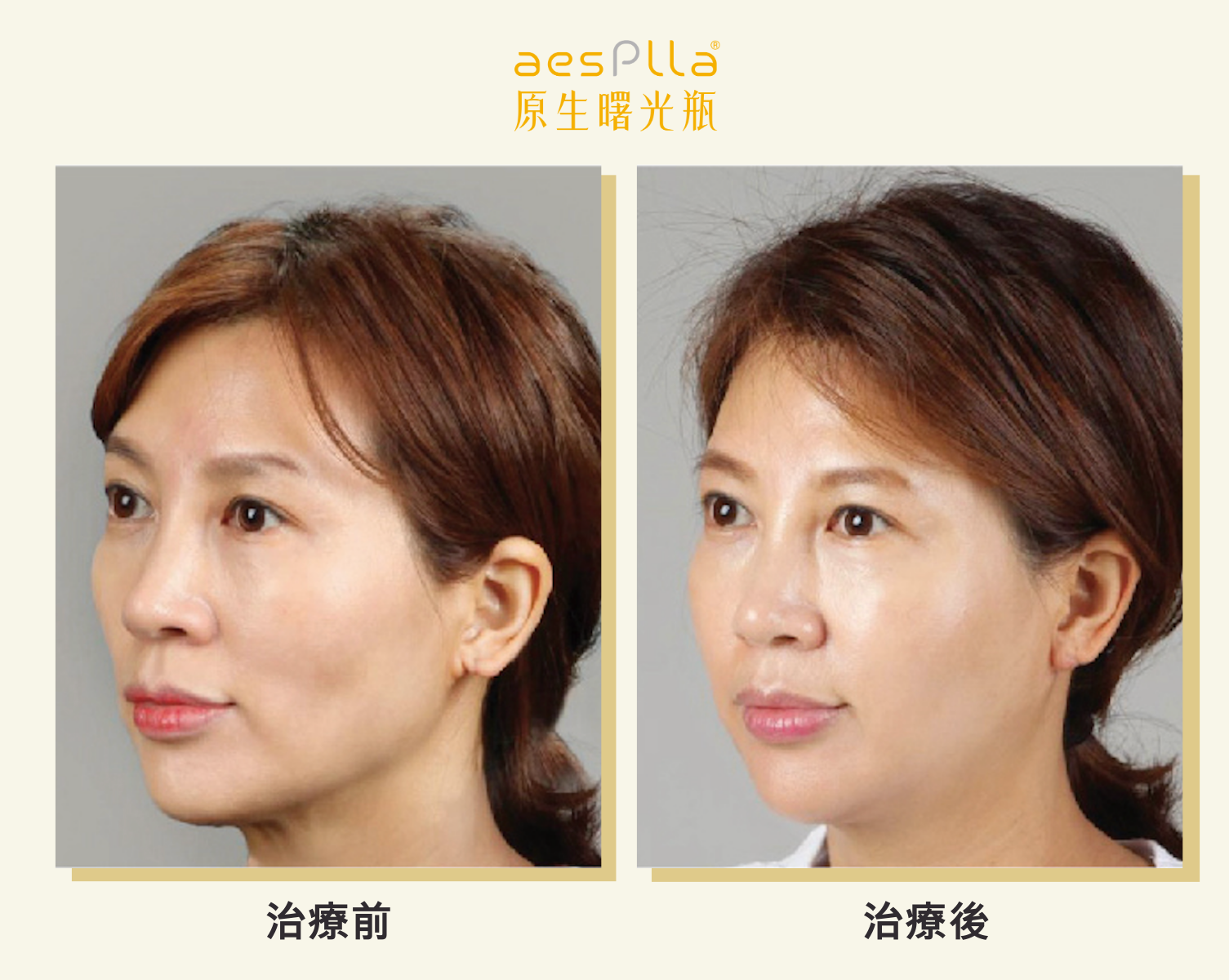 aesPlla&reg;艾莉雅案例治療前後