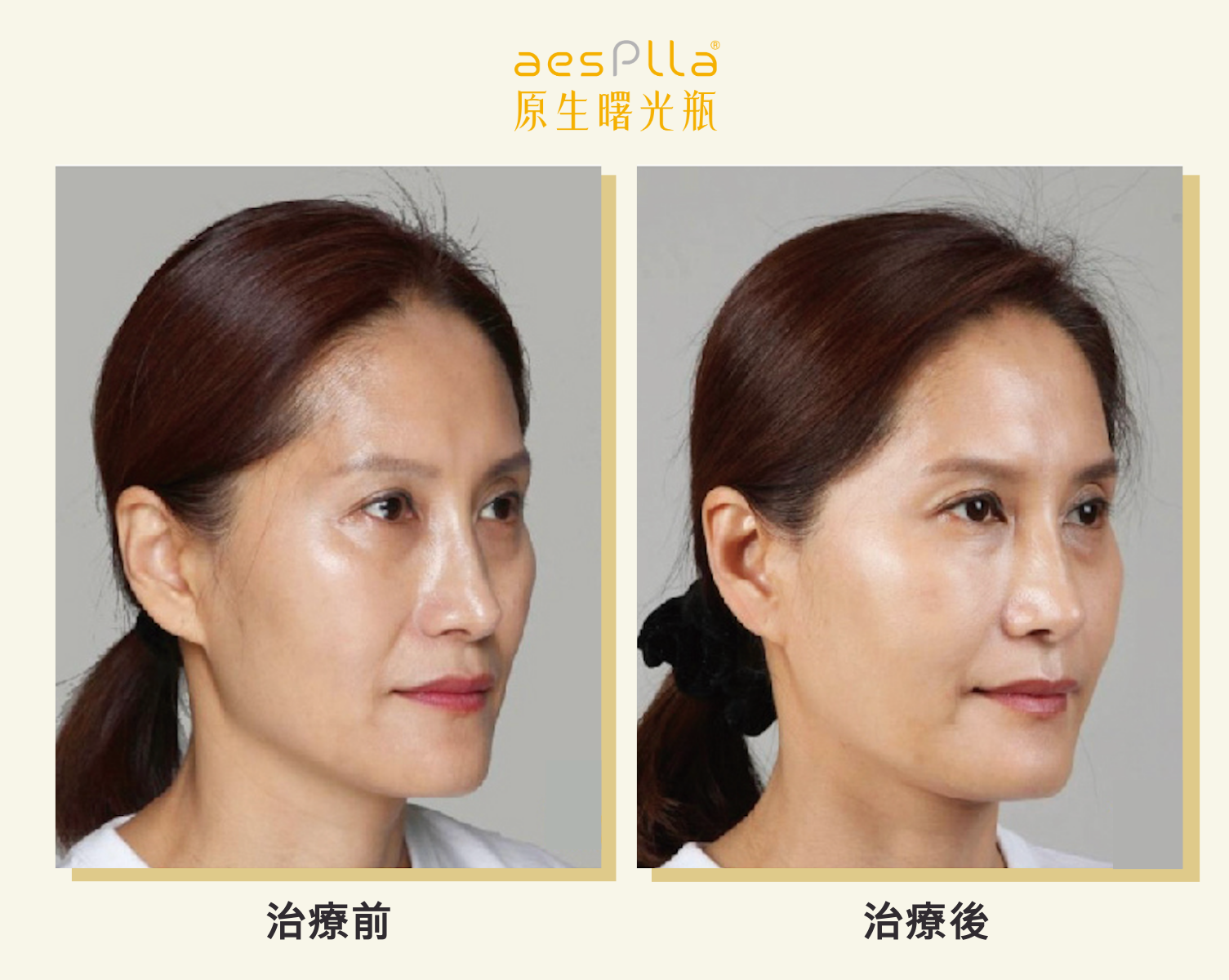 aesPlla&reg;艾莉雅案例