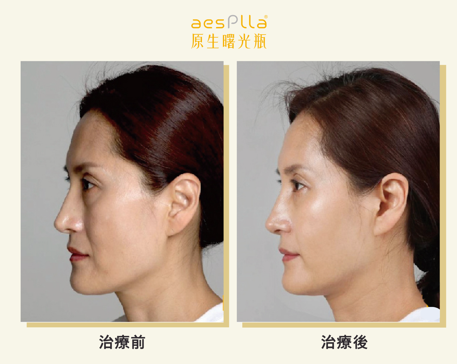 aesPlla&reg;艾莉雅案例治療前後