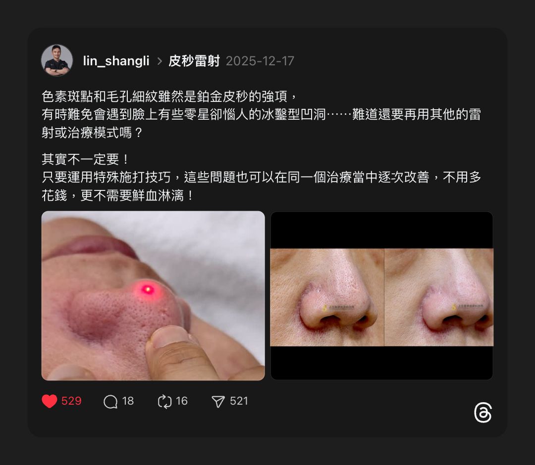 林上立醫師分享蜂巢皮秒治療案例，上立醫師運用特殊技巧，快速消除患者臉上的冰鑿型凹痘疤