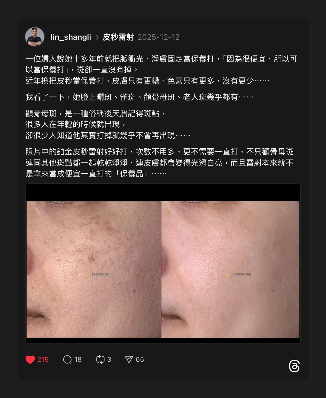 林上立醫師分享蜂巢皮秒治療案例，鉑金皮秒雷射好好打，次數不用多，曬斑、雀斑、顴骨母斑、老人斑三次解決