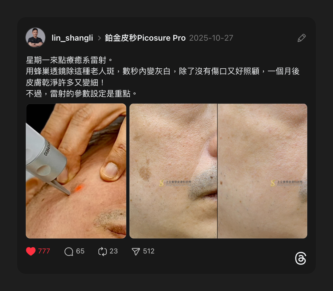 上立醫師分享案例，用蜂巢透鏡除這種老人斑，數秒內變灰白，除了沒有傷口又好照顧，一個月後皮膚乾淨許多又變細！