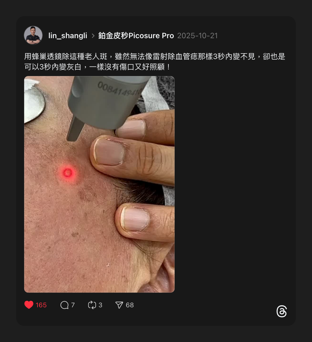 林上立醫師分享案例，蜂巢透鏡除老人斑可以3秒內變灰白，一樣沒有傷口又好照顧