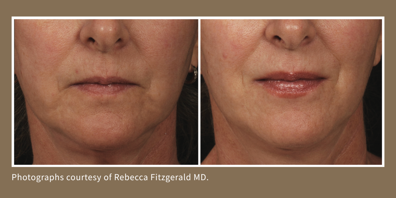 重建唇周的結構支撐