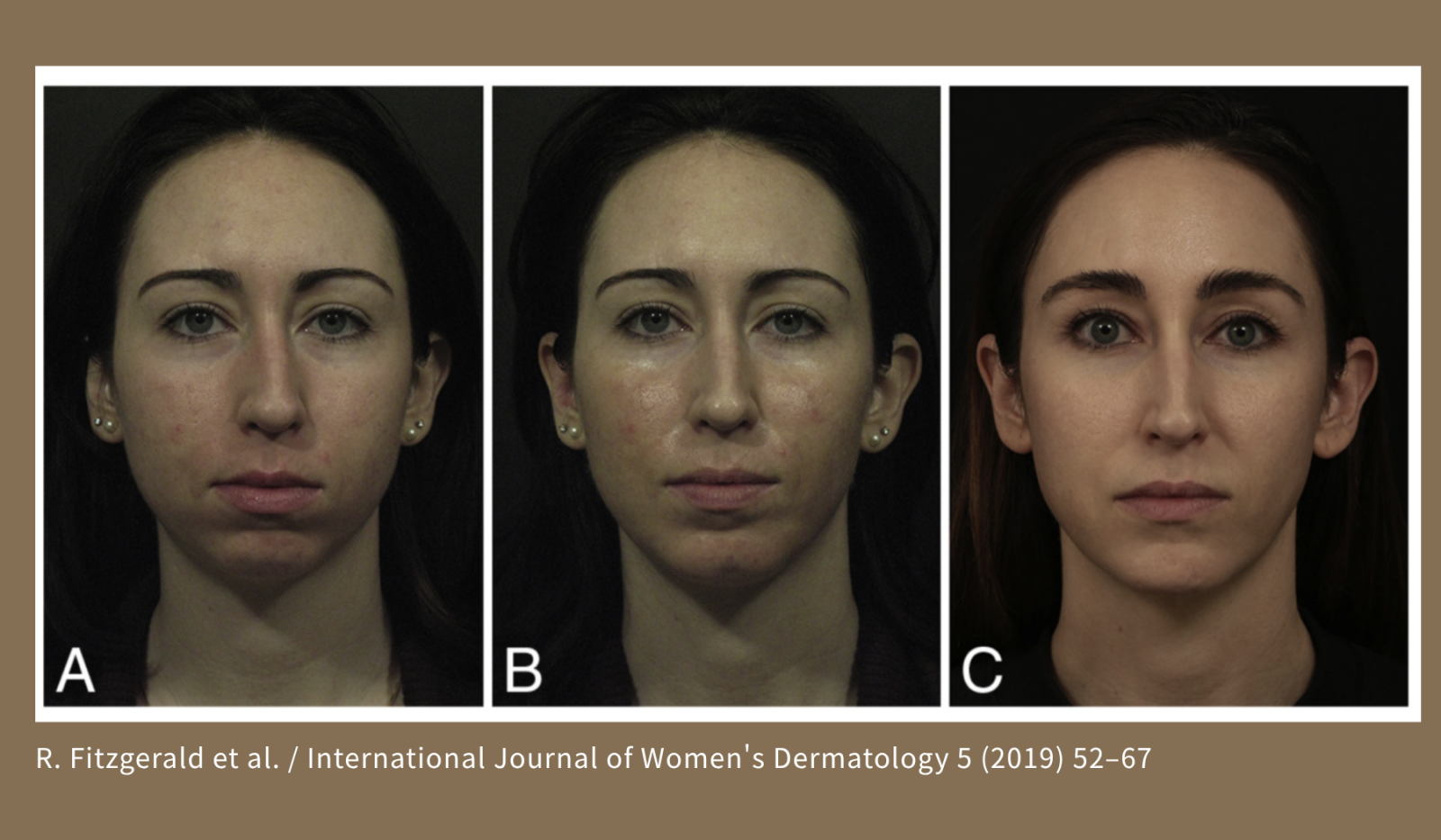 只填補嘴唇，未建立唇周支撐