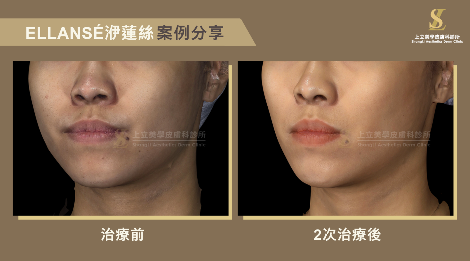 這是一個很典型因為唇周支撐不佳，進而影響唇形的案例。可見在治療之前，由於天生鼻基底和下巴支撐較差，導致唇形不佳，甚至有點暴牙感；但在林上立醫師運用洢蓮絲來強化顴骨的支撐，並增加鼻基底和下巴的立體度之後，不僅下半臉的比例更和諧好看，就連唇形也更立體、更精緻小巧。