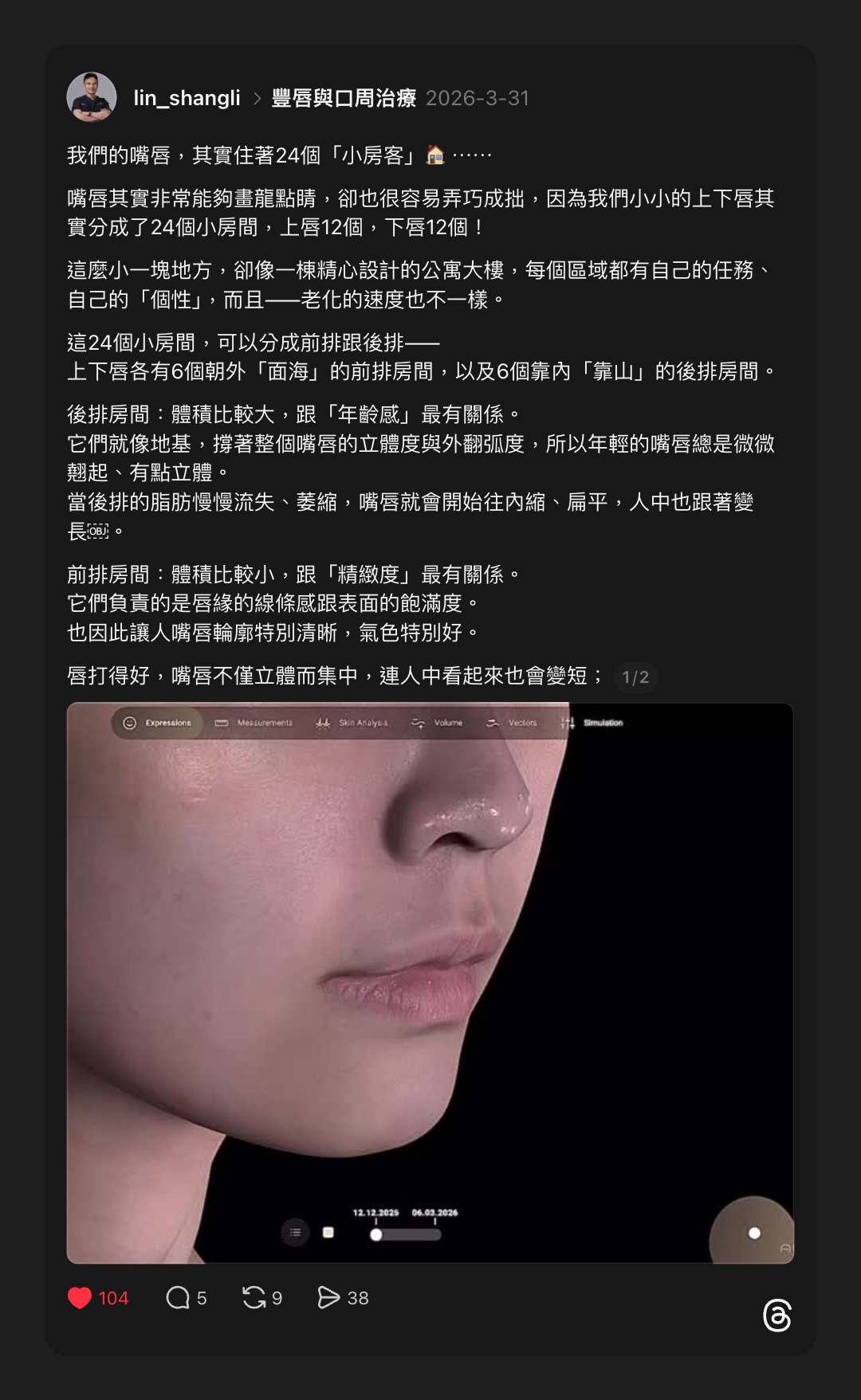 林上立醫師案例,使用玻尿酸豐唇,治療後效果自然飽滿。
