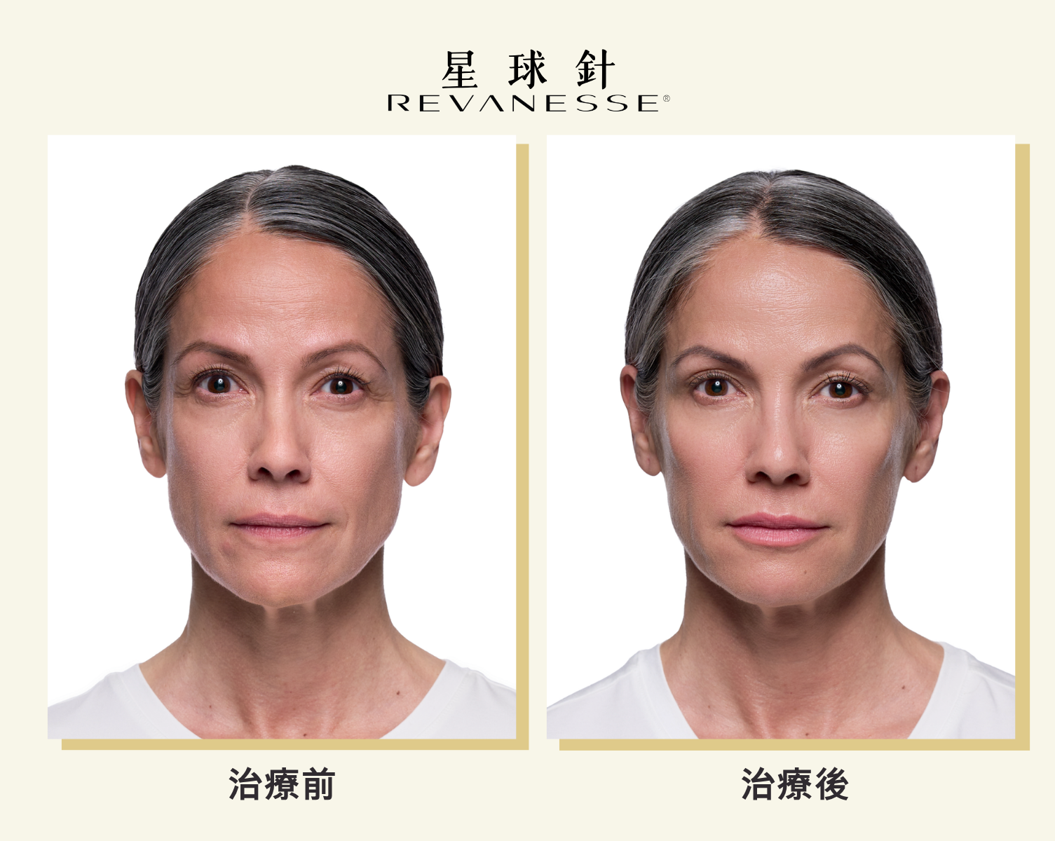 Revanesse&reg;星球玻尿酸的案例