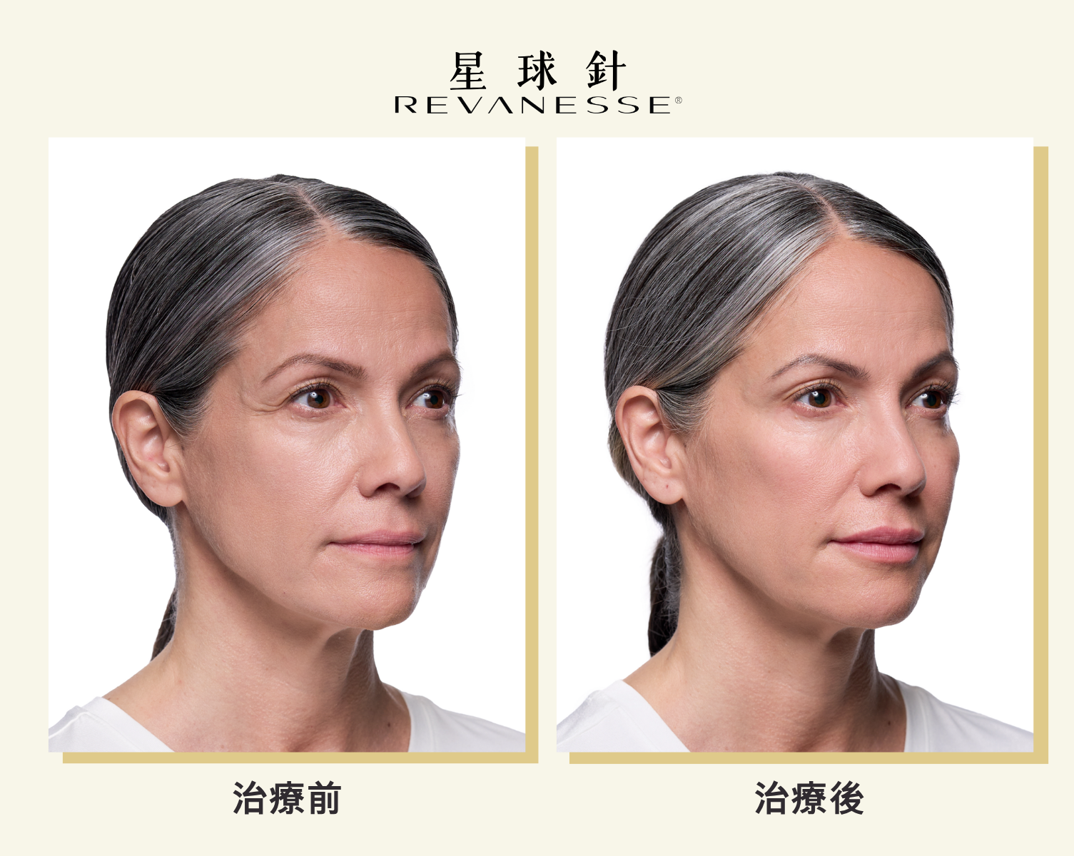 Revanesse&reg;星球玻尿酸的案例