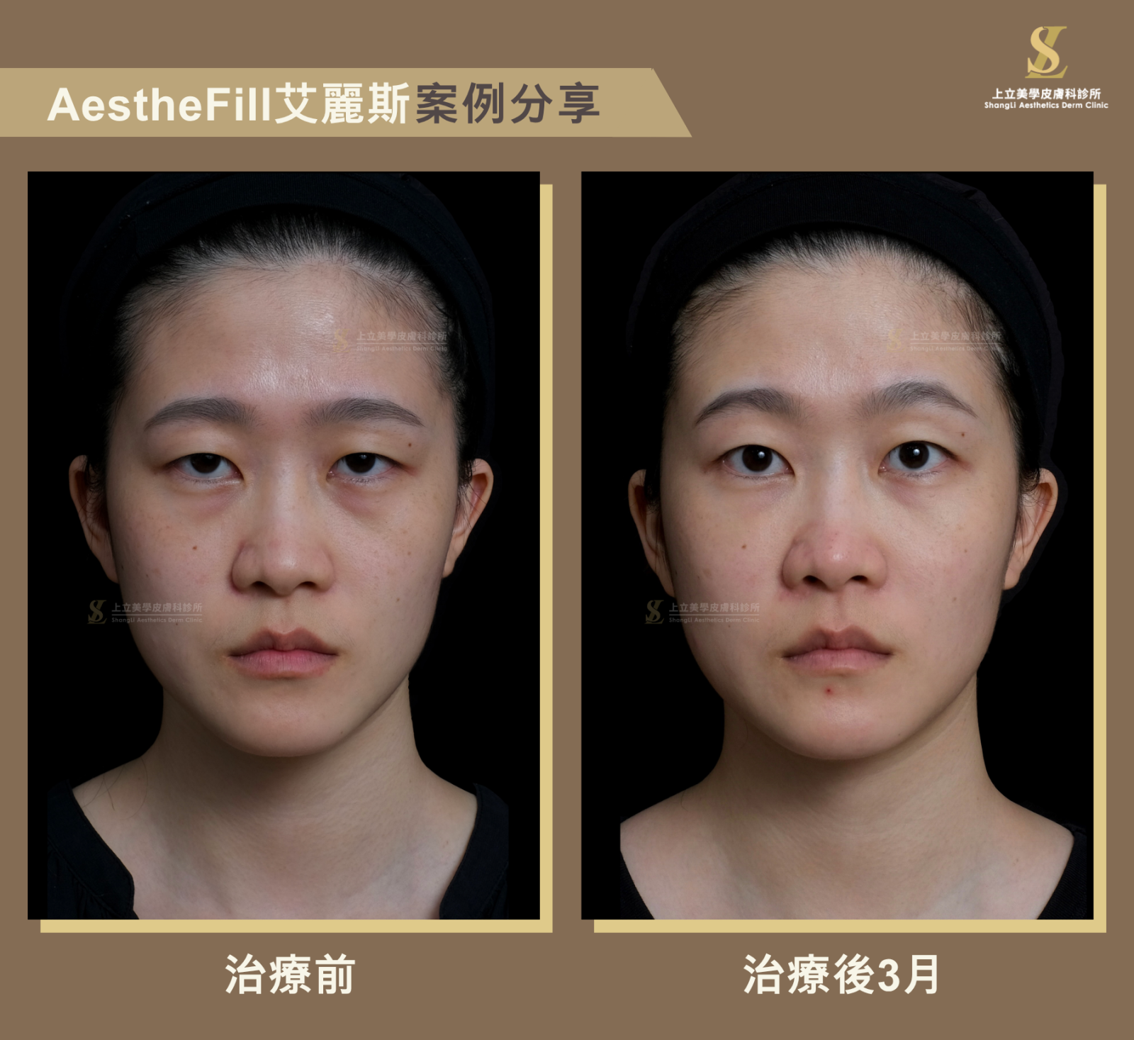 重建中臉支撐，聚焦輪廓、改善眼神疲憊感