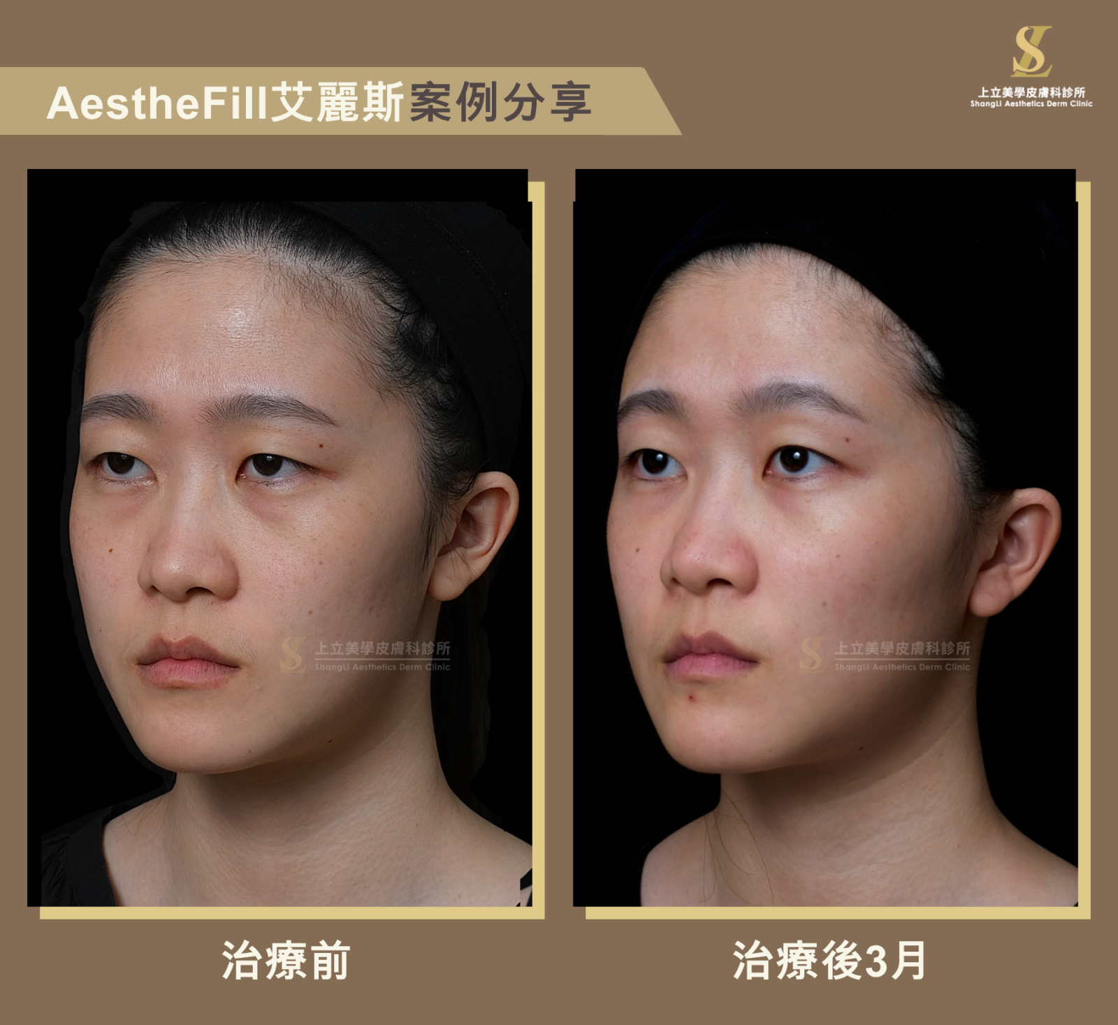 重建中臉支撐，聚焦輪廓、改善眼神疲憊感