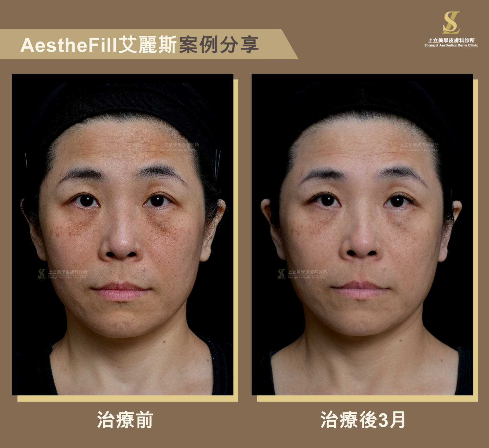 結構流失合併膚質老化的分層調整