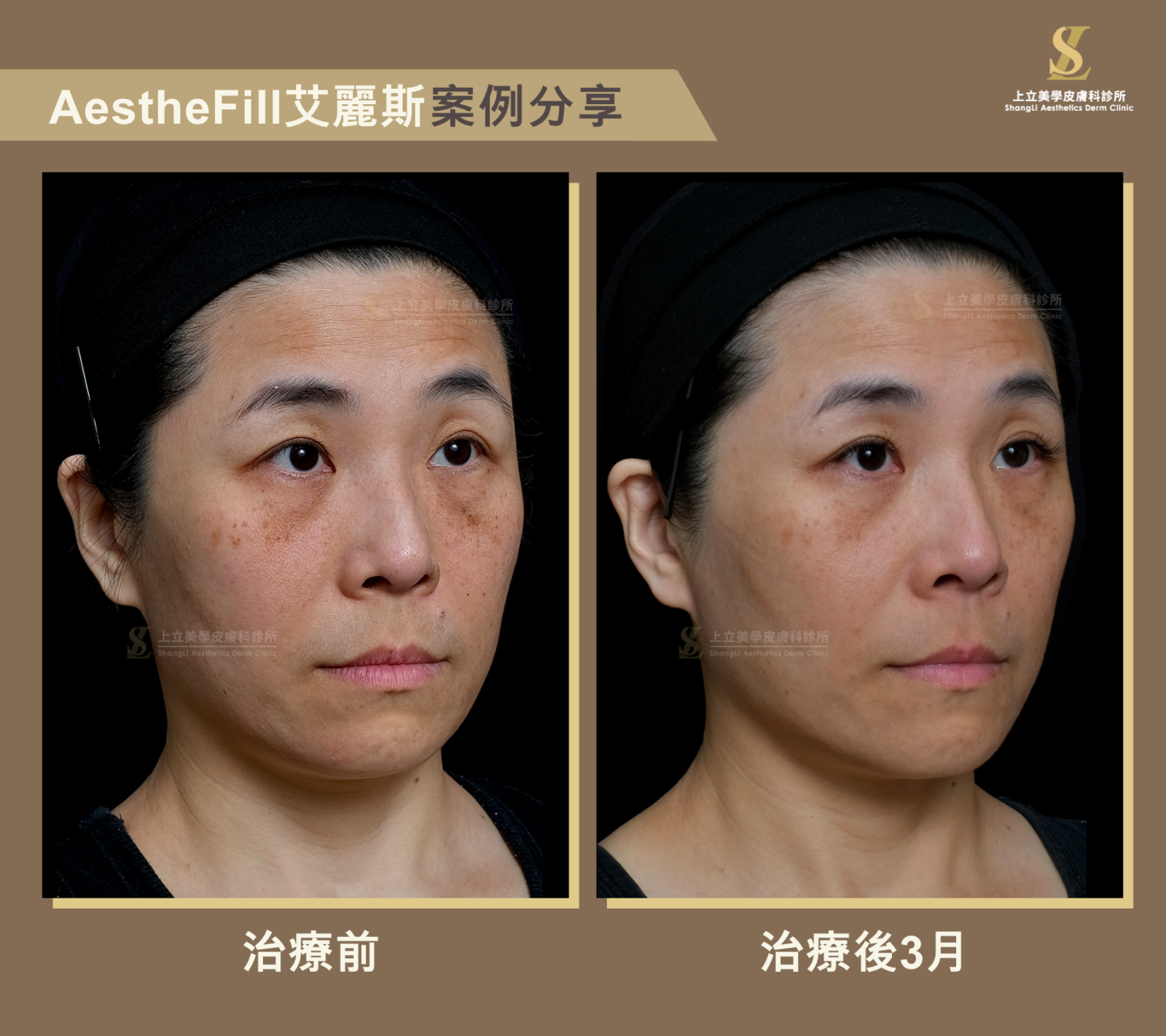 結構流失合併膚質老化的分層調整