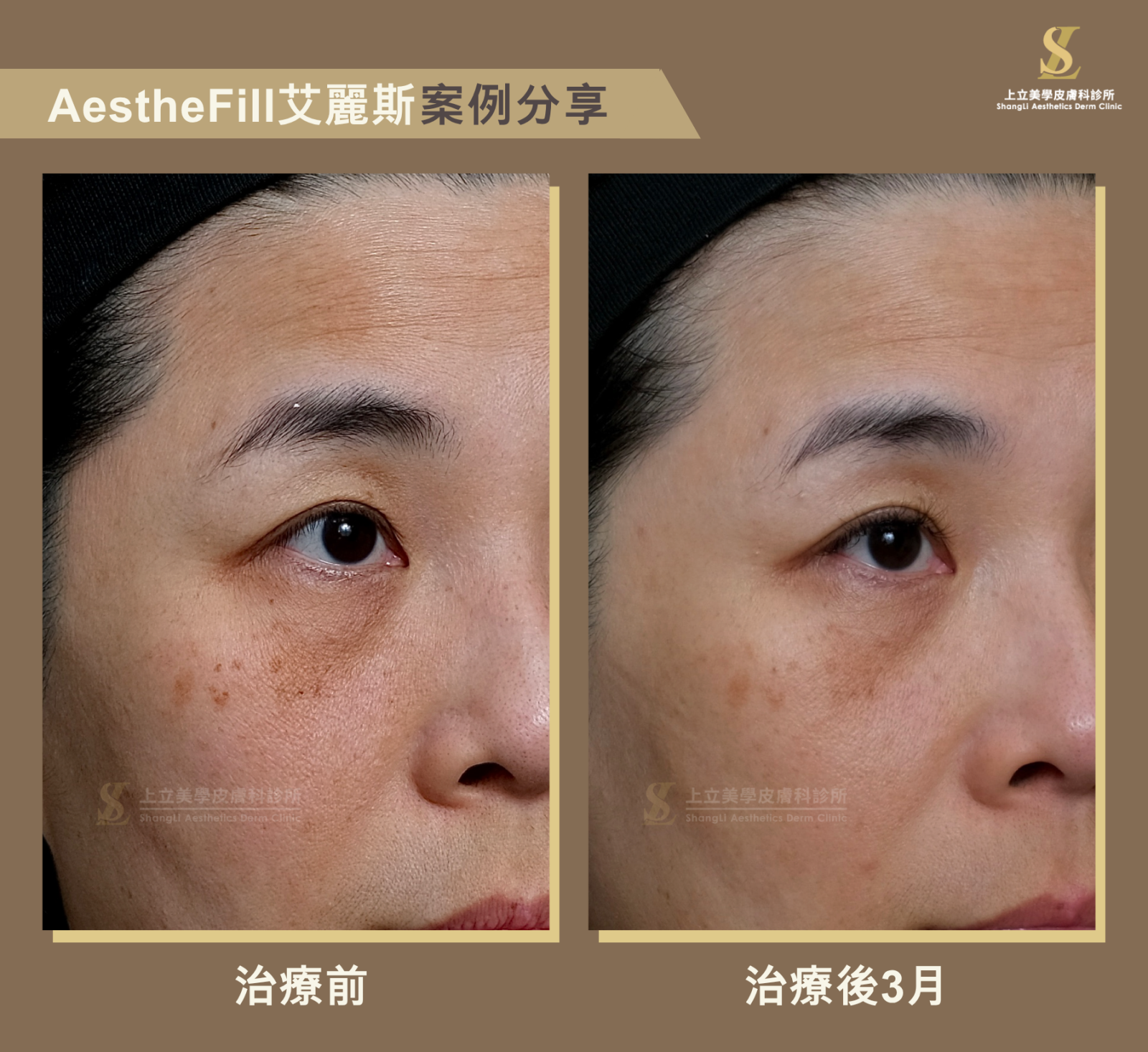 結構流失合併膚質老化的分層調整