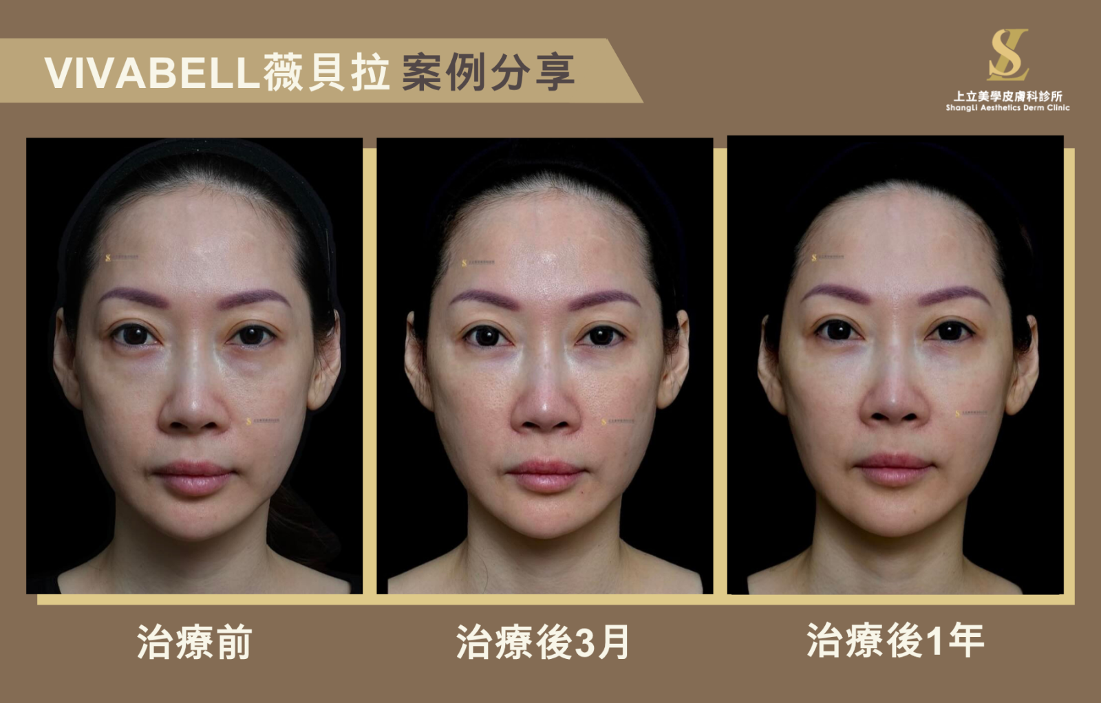林上立醫師使用 Vivabell 薇貝拉重建中臉支撐，改善淚溝、眼下凹陷與蘋果肌下垂，治療後3個月輪廓明顯提升，1年後效果依然穩定自然。