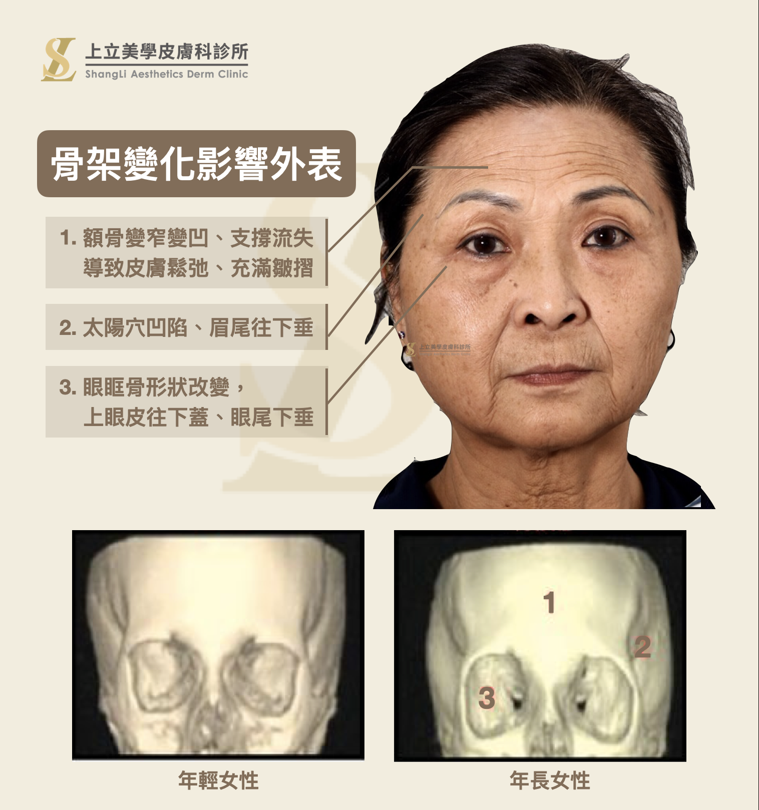 隨著骨架老化流失、形狀改變，額頭的支撐力也會逐漸下降