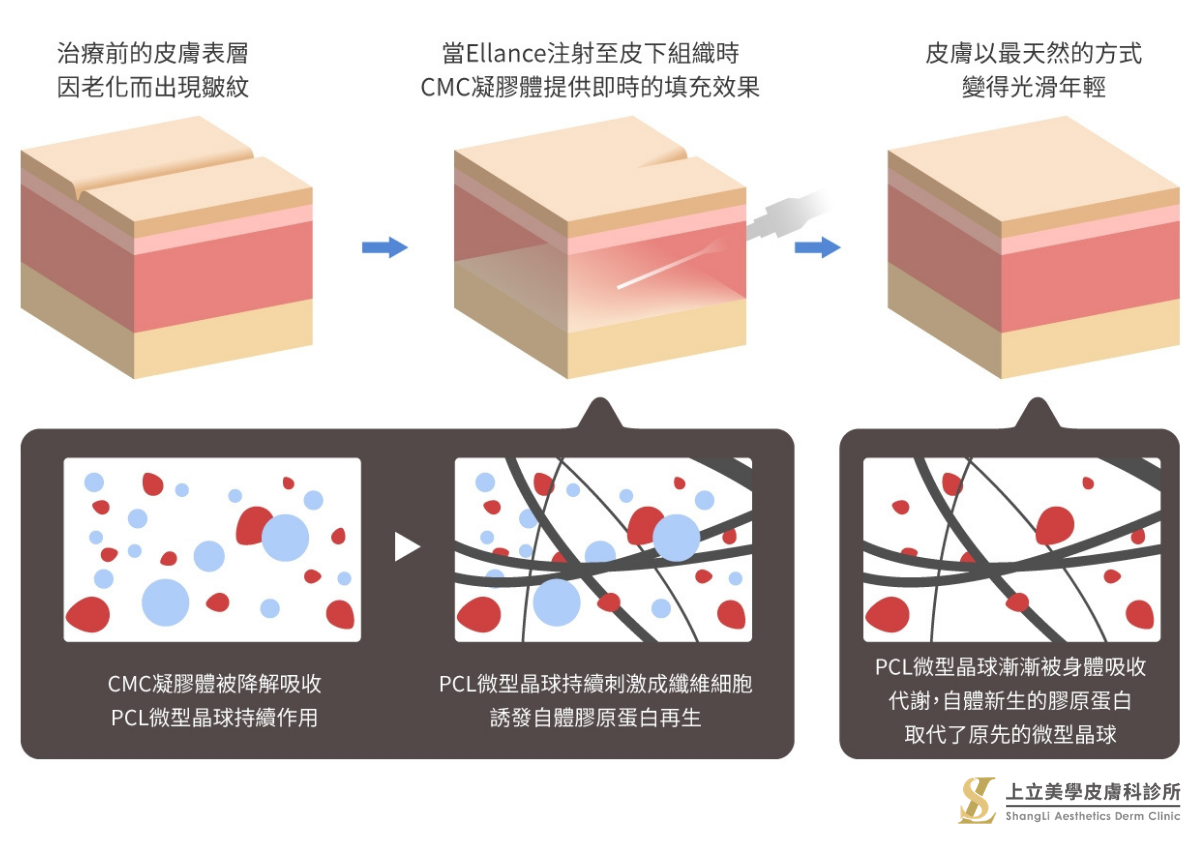 洢蓮絲作用原理