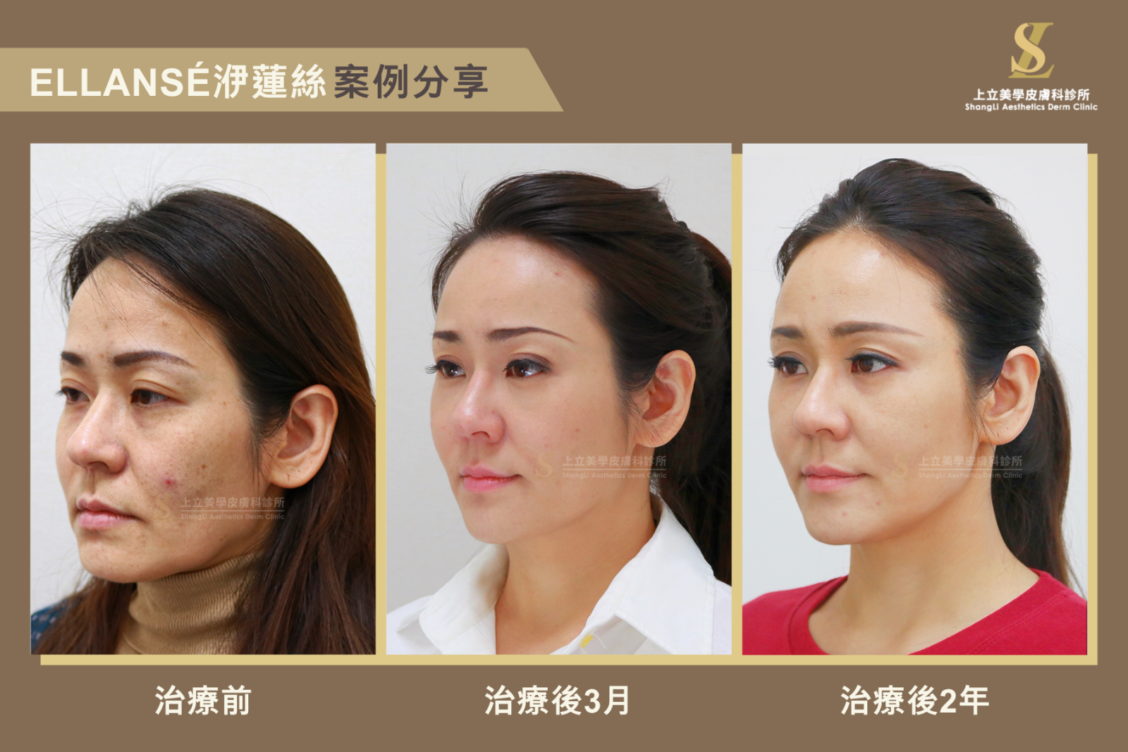 ELLANS&Eacute;洢蓮絲可以在治療當下就提供完整支撐，幫助醫師明確掌握注射效果，讓治療更加精準。