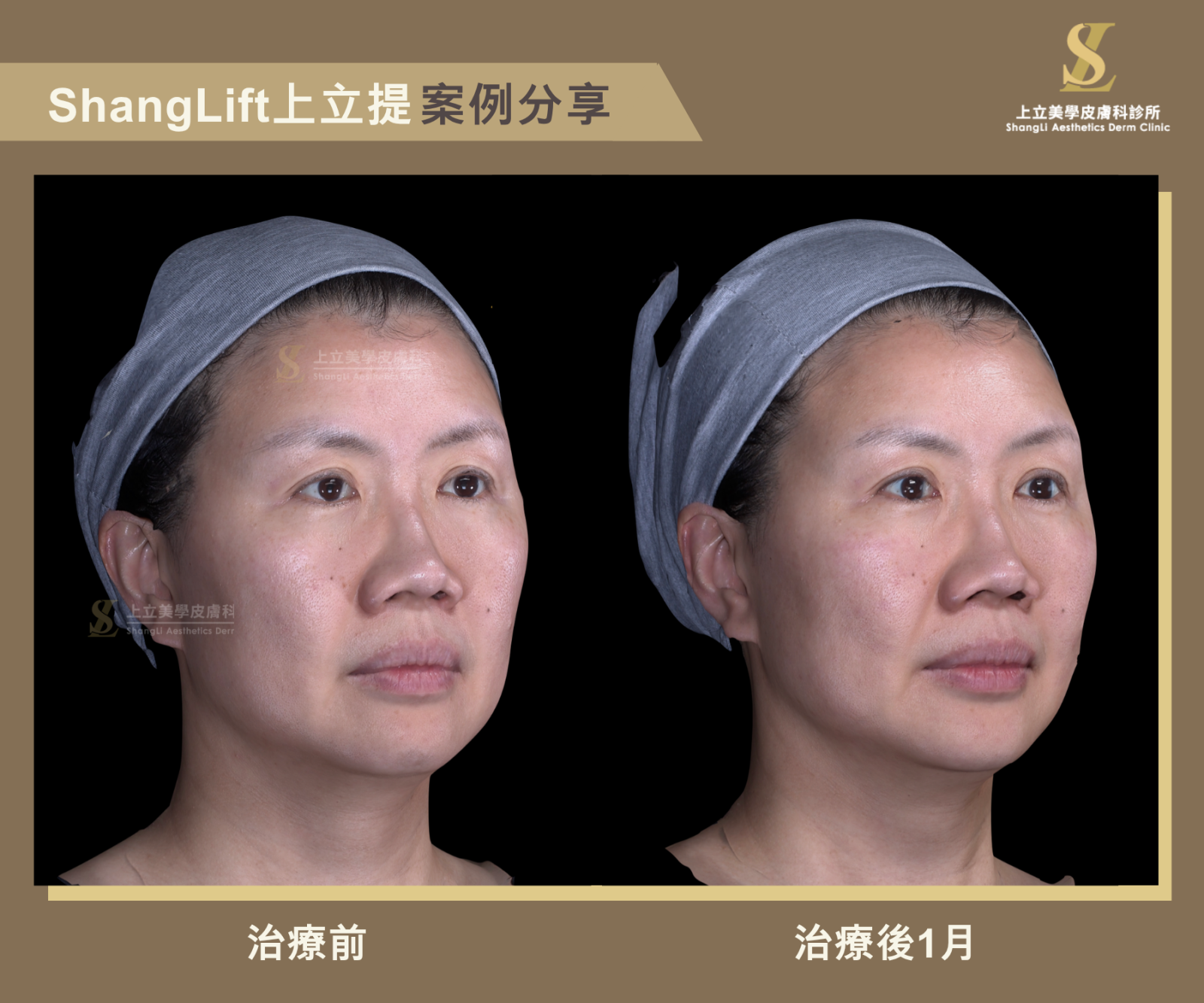 林上立醫師運用了ShangLift注射技巧