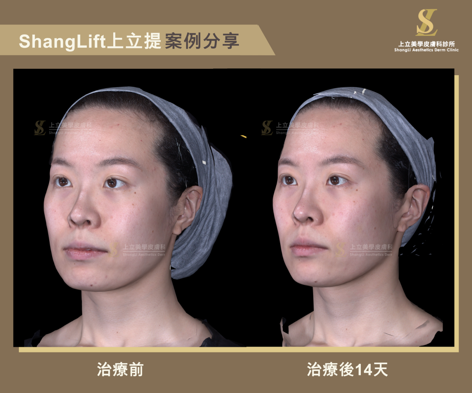 林上立醫師一樣運用了ShangLift組織復位的技巧