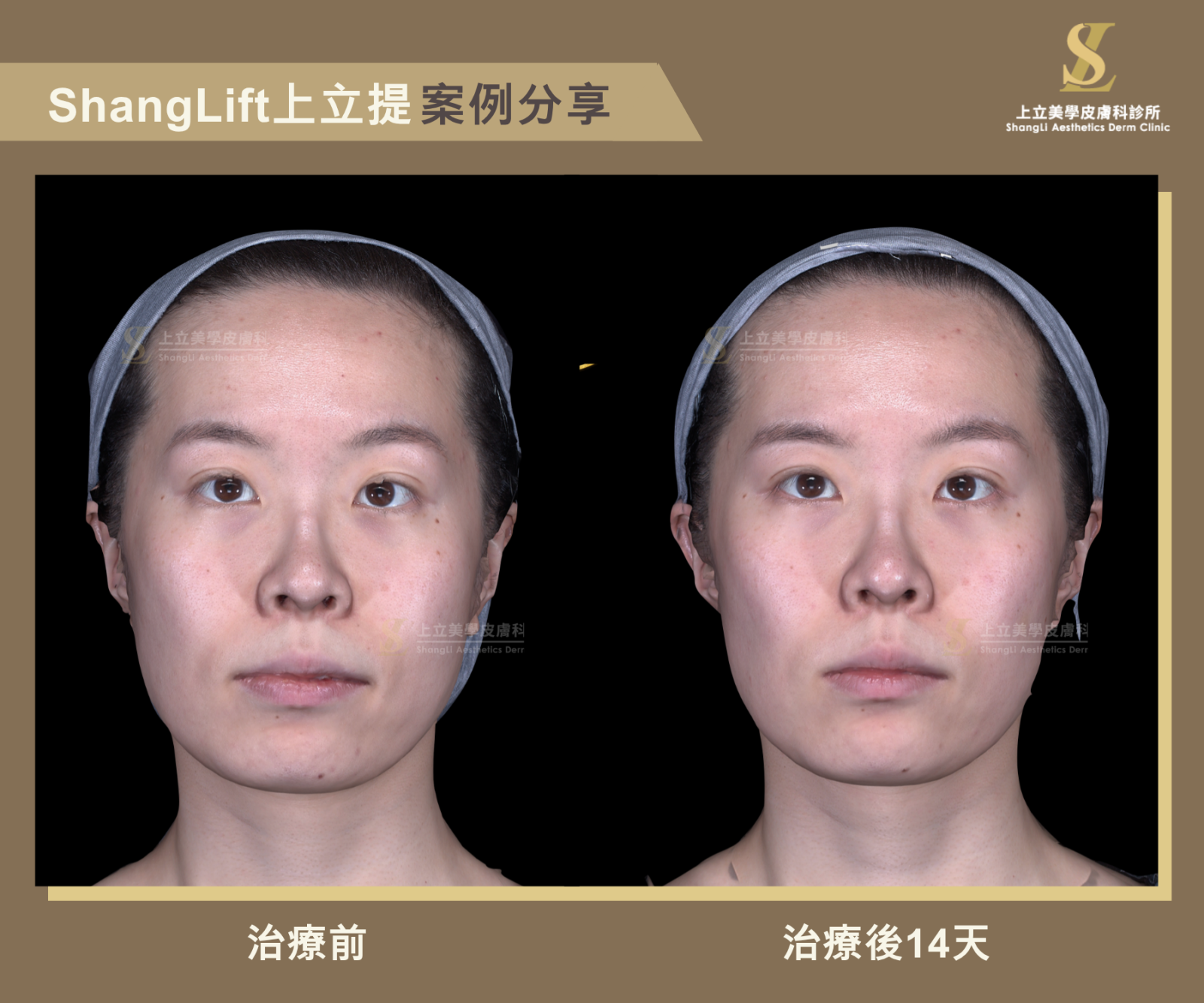 林上立醫師一樣運用了ShangLift組織復位的技巧