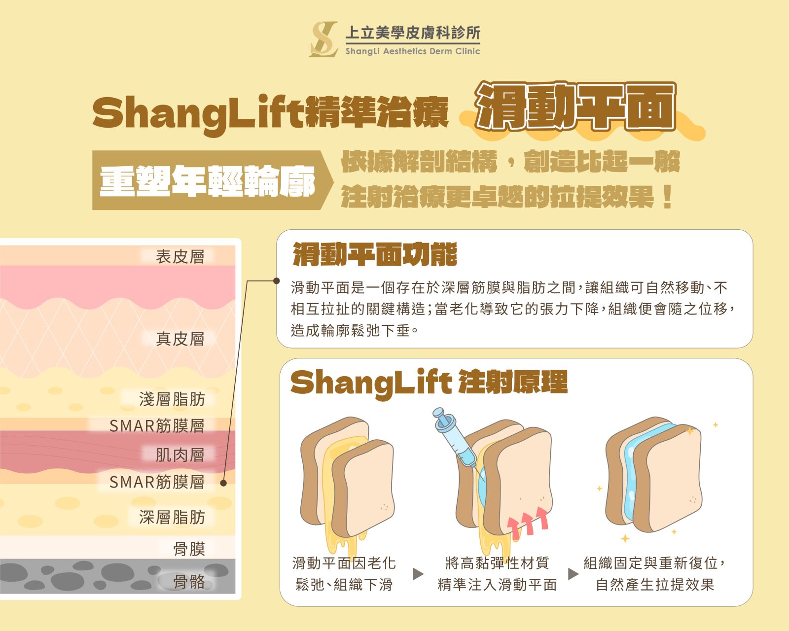 ShangLift的注射邏輯：就像「吐司夾果醬」