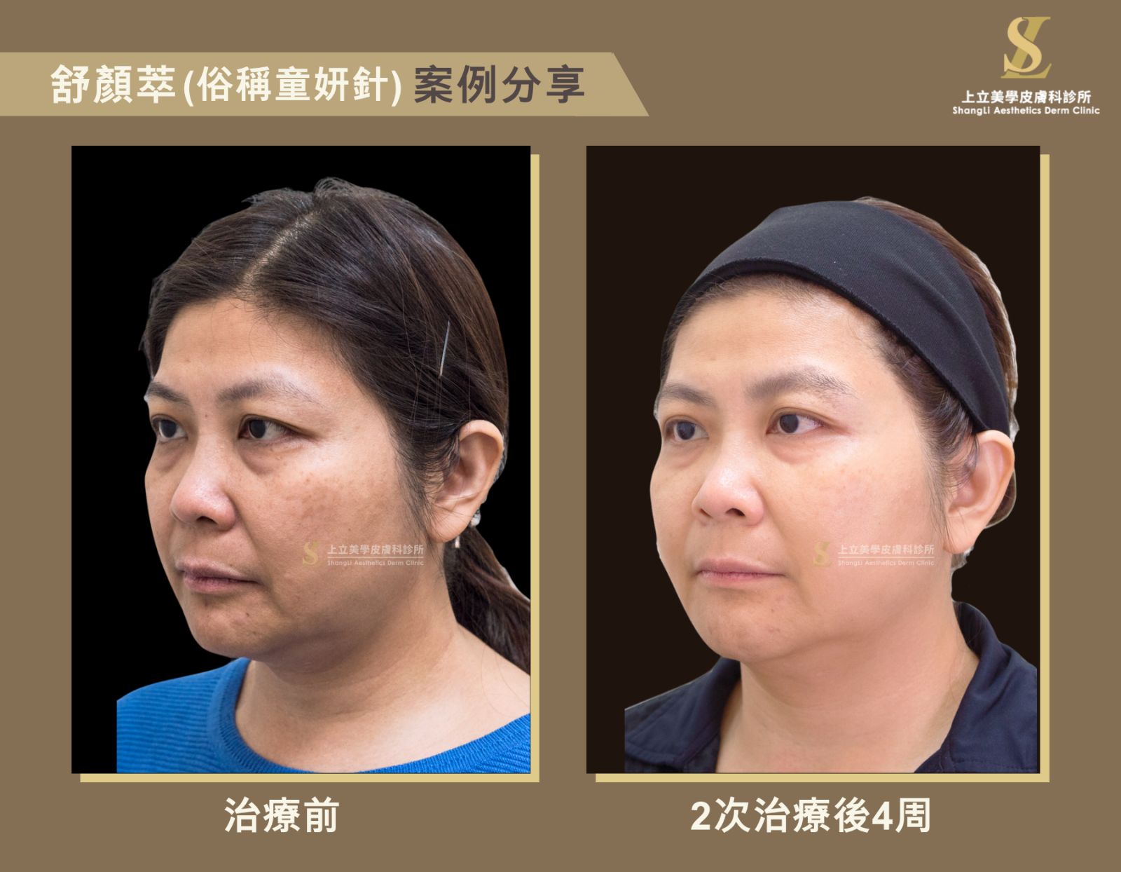 面對流失更為嚴重的情況，林上立醫師與求診者溝通後採取2次治療
