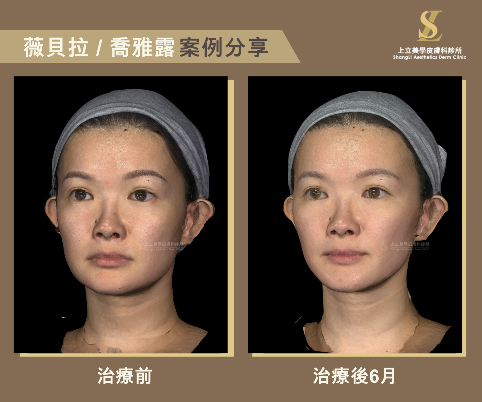 根據治療需求不同，也能單獨使用大分子薇貝拉來改善深層結構的支撐力與輪廓立體度