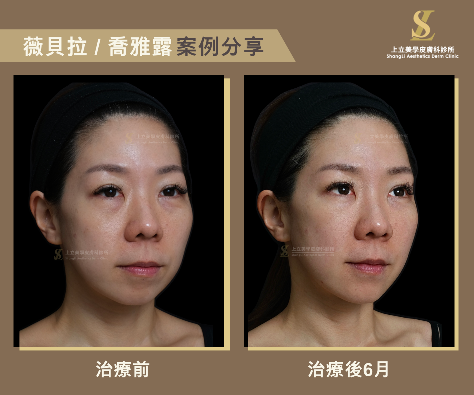 林上立醫師在利用VIVABELLA薇貝拉適當改善太陽穴凹陷、淚溝和法令紋的情況後，刻意不過度修飾下巴線條
