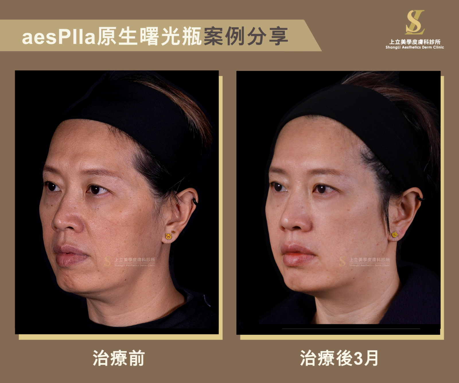 林上立醫師使用aesPlla艾莉雅進行治療，從案例中可以看到改善臉頰凹陷蘋果肌變立體，惱人的淚溝、法令紋、木偶紋也變得不明顯，整體輪廓線條更俐落、氣色也更好