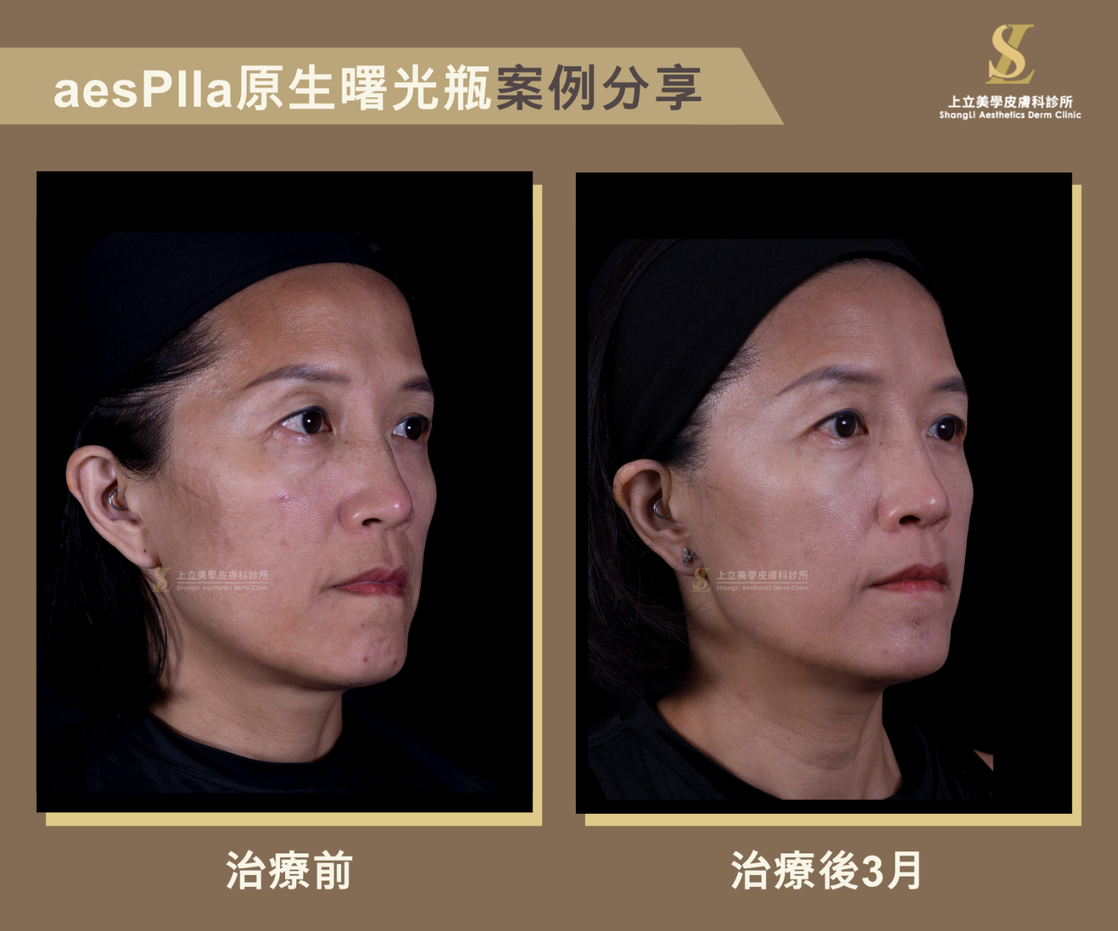 林上立醫師一樣針對幾個流失較嚴重的區域，包含額頭、太陽穴、耳前、上顎骨、下巴等區域，分別利用aesPlla艾莉雅來重建深層支撐與臉部立體度