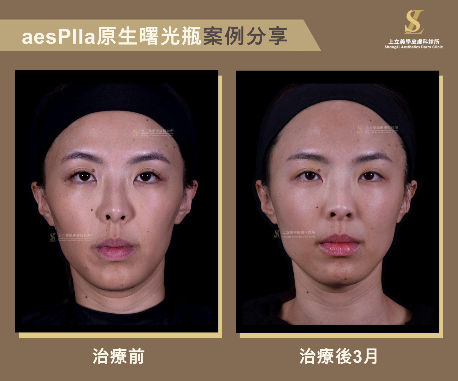 林上立醫師 aesPlla原生曙光瓶治療案例，術前與治療後3個月對比，臉部輪廓更緊緻、膚質改善與自然膠原增生效果。