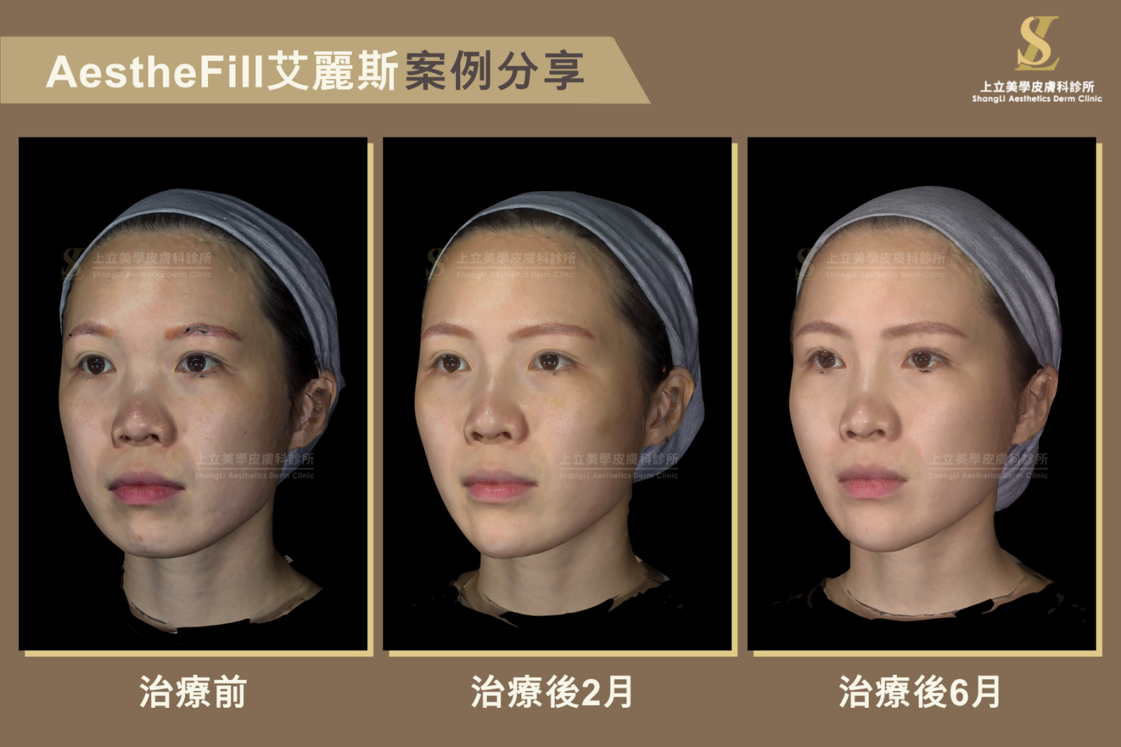 林上立醫師 AestheFill艾麗斯治療案例，術前、治療後2個月與6個月對比，可觀察到臉部輪廓更立體、肌膚更緊緻細緻，整體呈現自然年輕化效果。