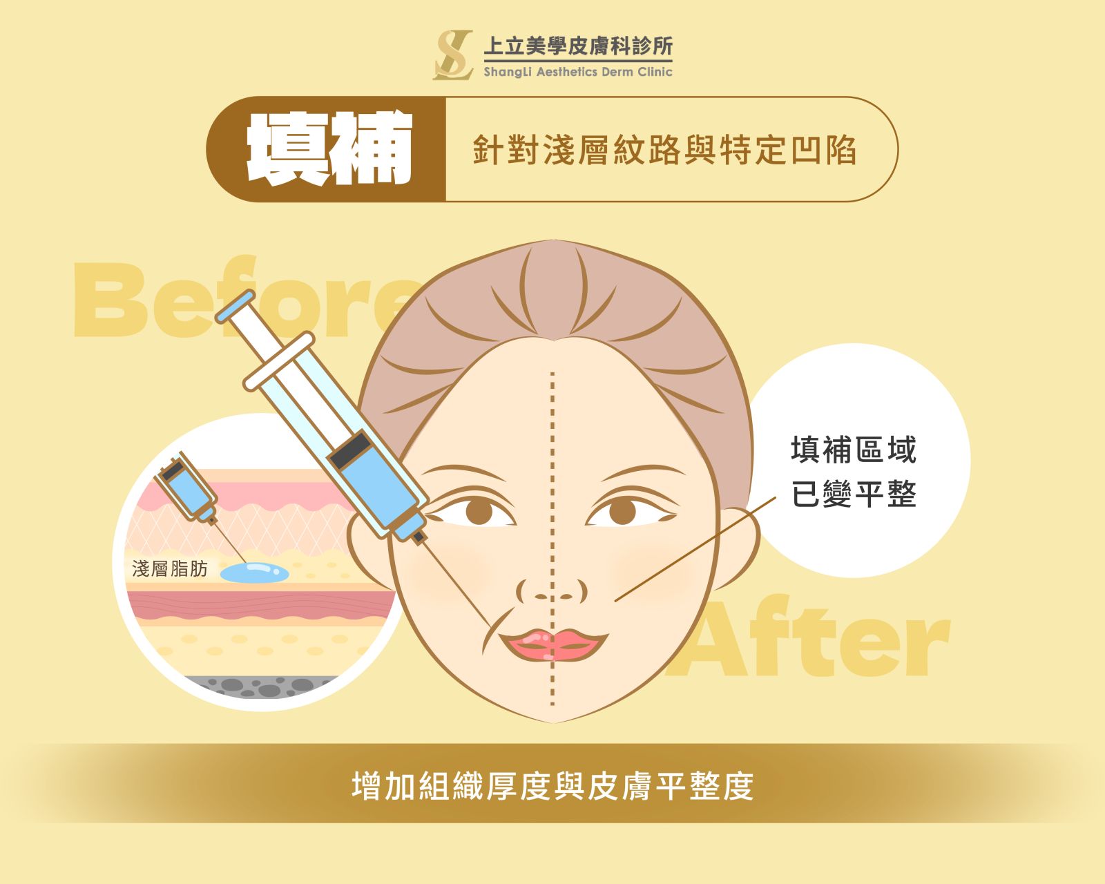 醫美注射微整形-支撐填補填充差異