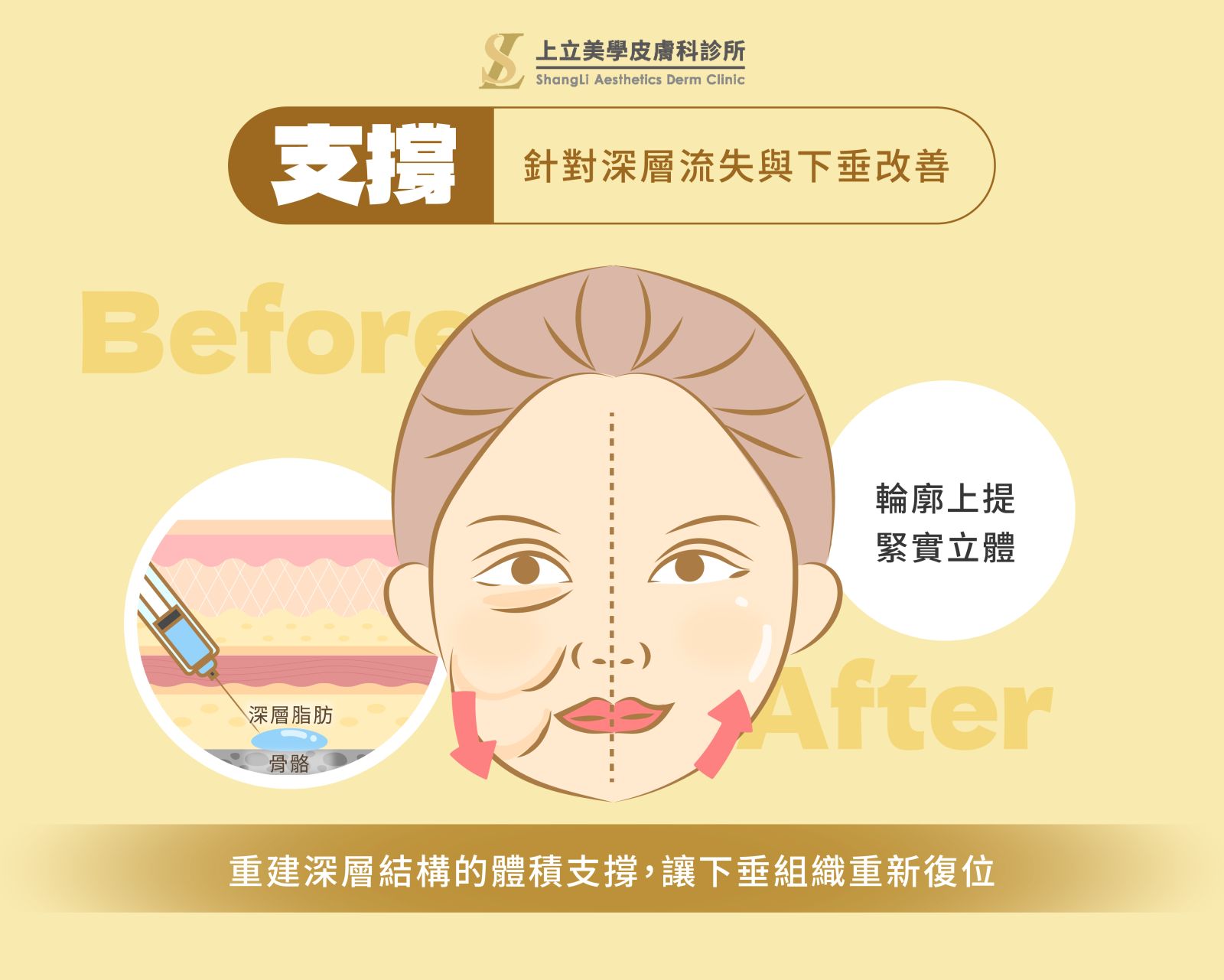 醫美注射微整形-支撐填補填充差異