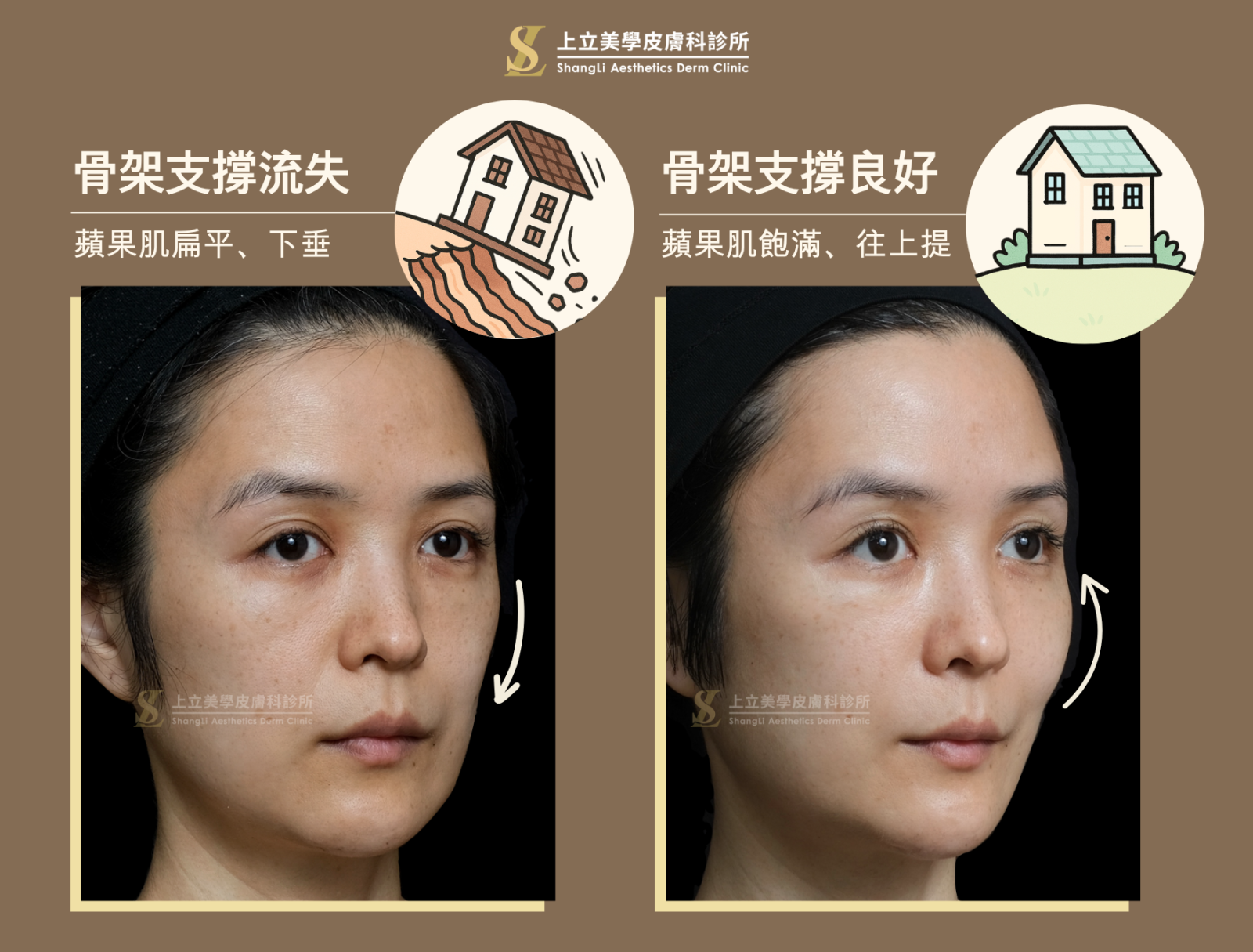 蘋果肌骨架支撐