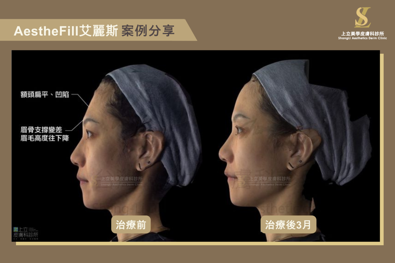 額頭填充案例:林上立醫師使用艾麗斯治療,改善額頭扁平、太陽穴凹陷與眉骨支撐不足,治療 3 個月後額頭線條更立體、更年輕自然。