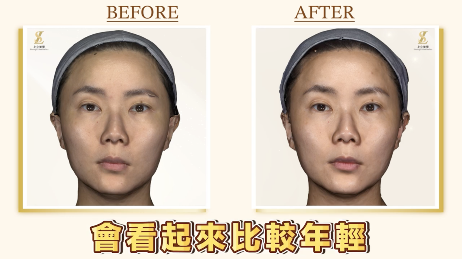 上立醫師額頭醫美案例,使用大小分子薇貝拉,同步優化額頭支撐與膚質