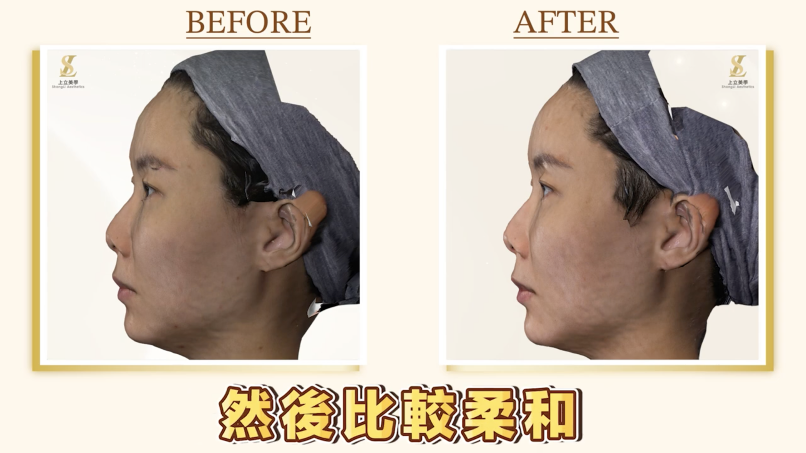上立醫師額頭醫美案例,使用大小分子薇貝拉,同步優化額頭支撐與膚質,側面圖