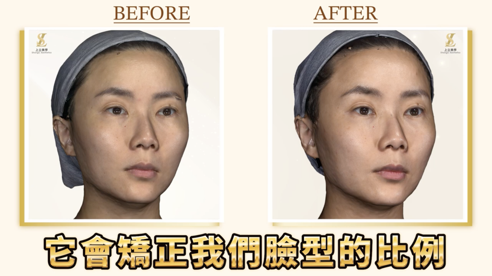 上立醫師額頭醫美案例,使用大小分子薇貝拉,同步優化額頭支撐與膚質(45度角圖)