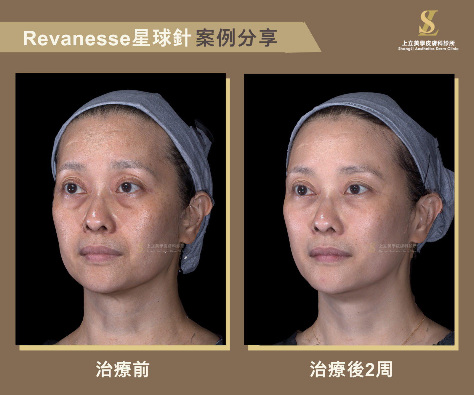 上立醫師的星球玻尿酸效果案例,治療前後 2 週對比,改善淚溝陰影、蘋果肌流失與臉部輪廓鬆弛,呈現自然年輕的眼周與臉部線條。