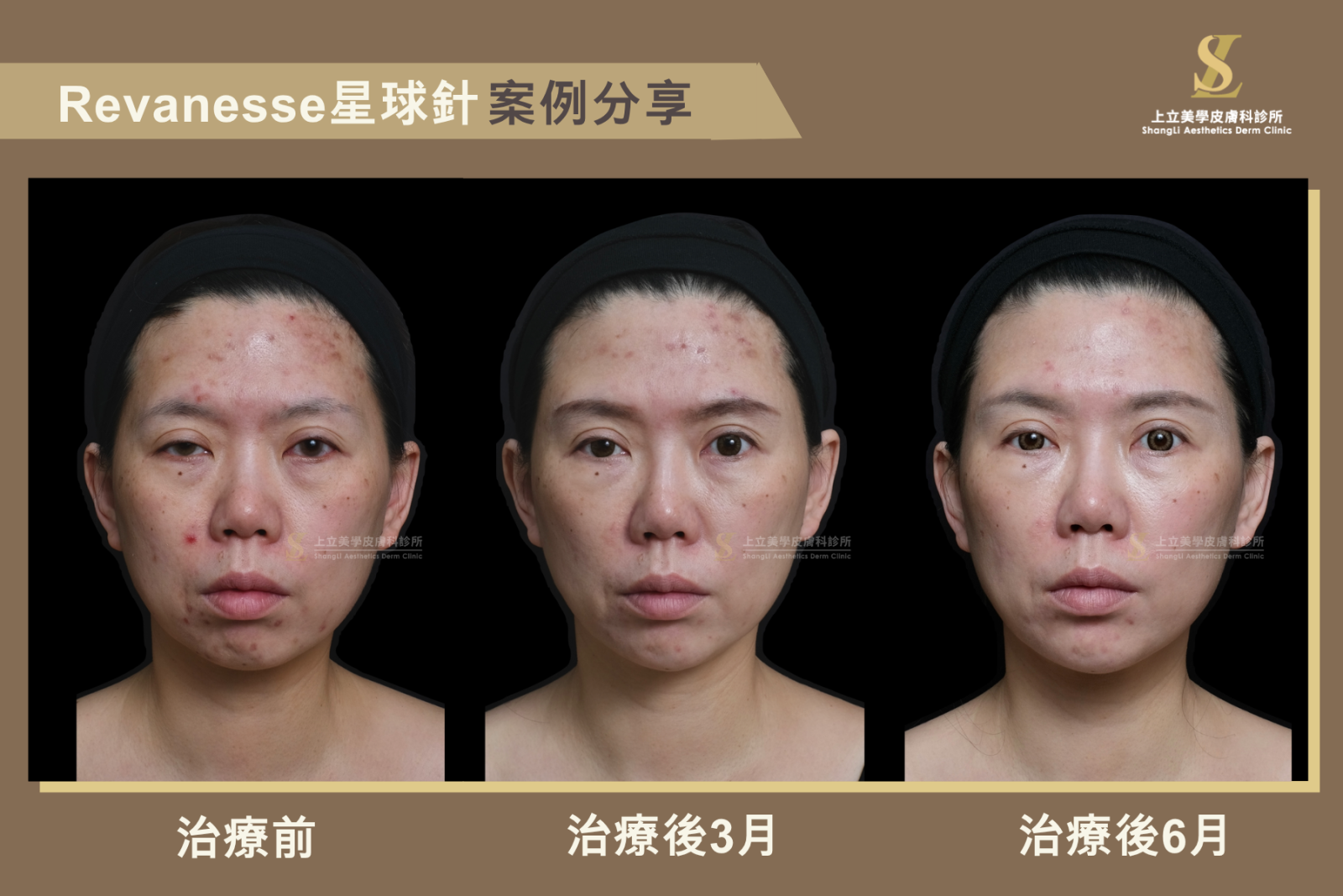星球玻尿酸效果比較,治療3個月與6個月正面追蹤,改善大小眼、臉部支撐與全臉輪廓。