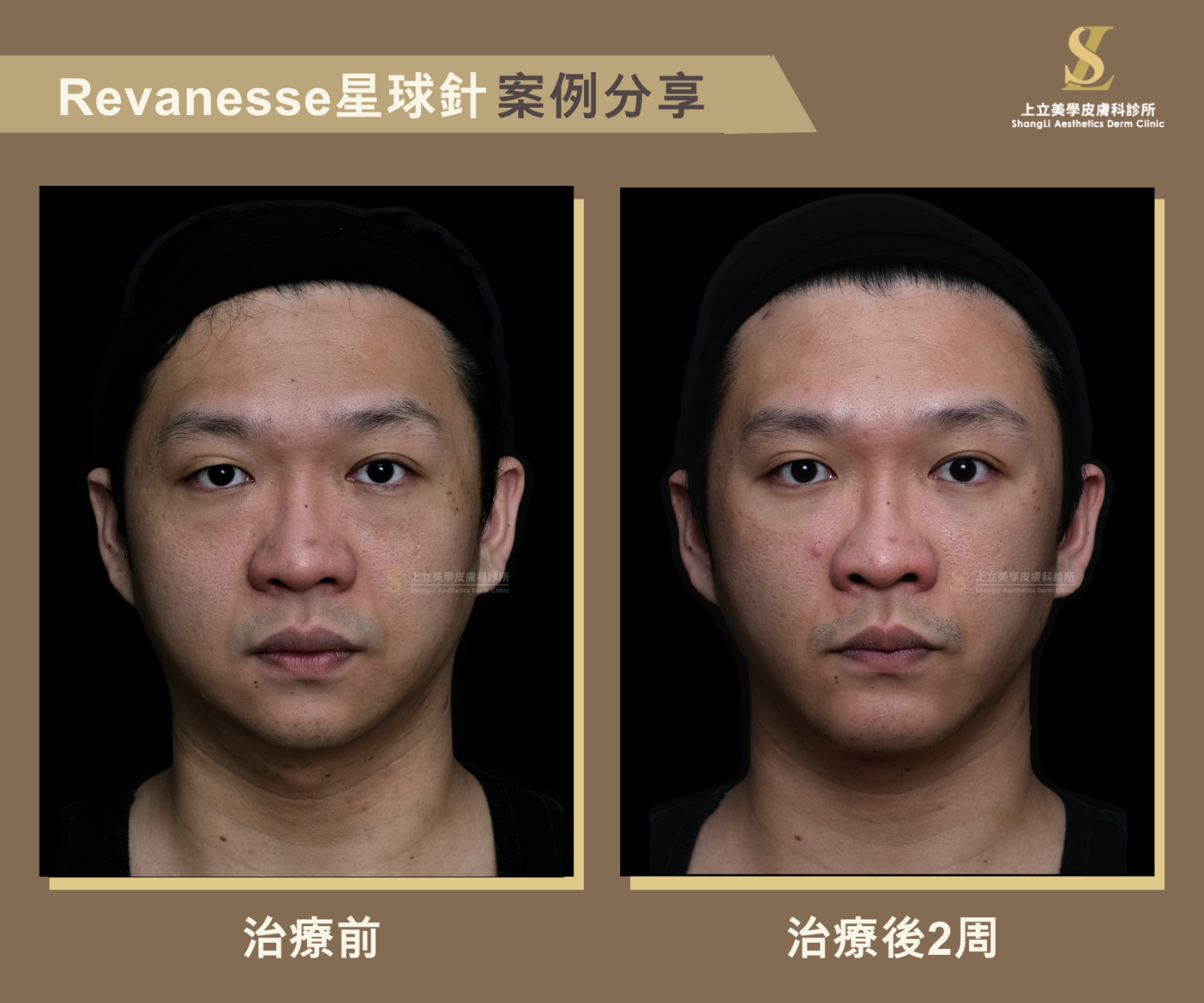 星球玻尿酸治療前後 2 週正面追蹤,改善深層支撐不足、下顎線條與臉部比例,使男性輪廓更俐落自然,呈現穩定的星球玻尿酸效果。