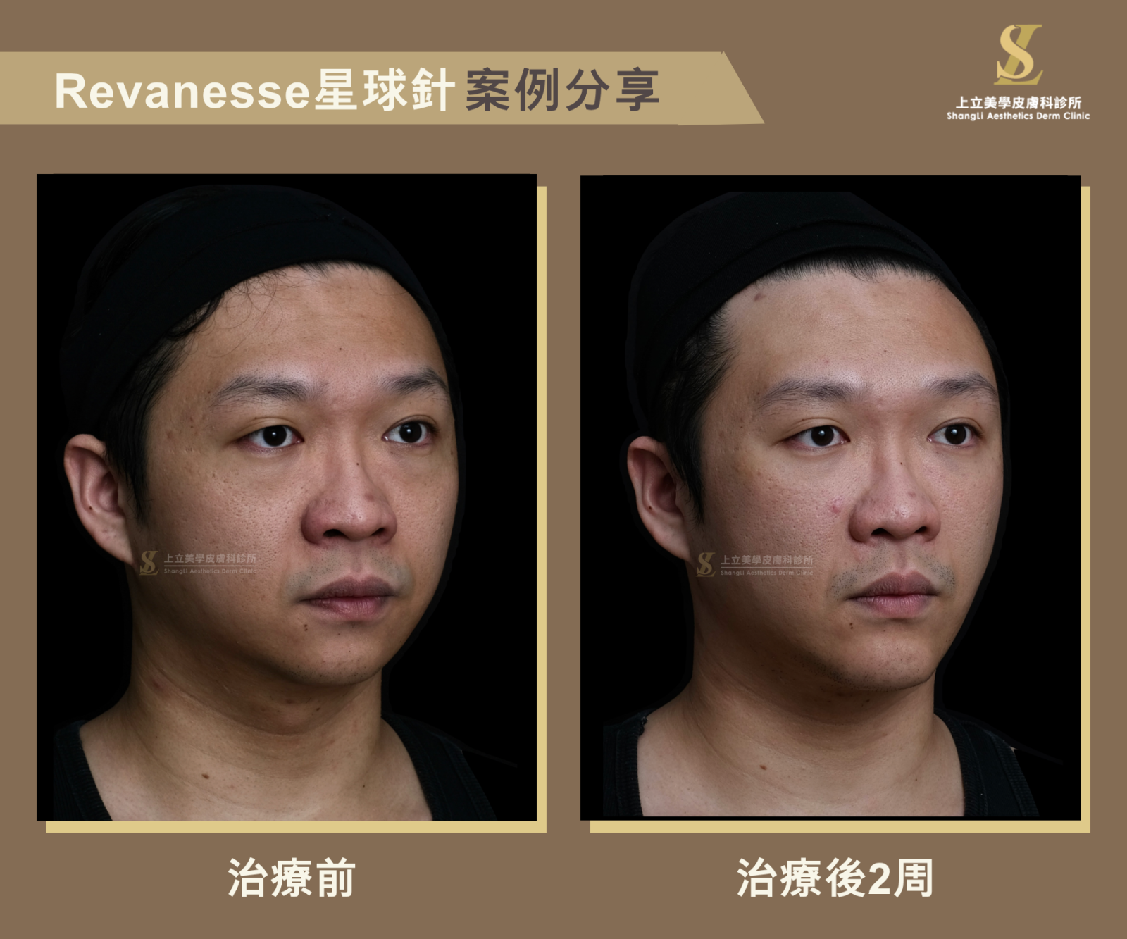星球玻尿酸治療前後 2 週 45 度角案例,重建中臉與下臉深層支撐,改善眼袋、輪廓下垂與臉部線條,打造自然立體的男性輪廓。
