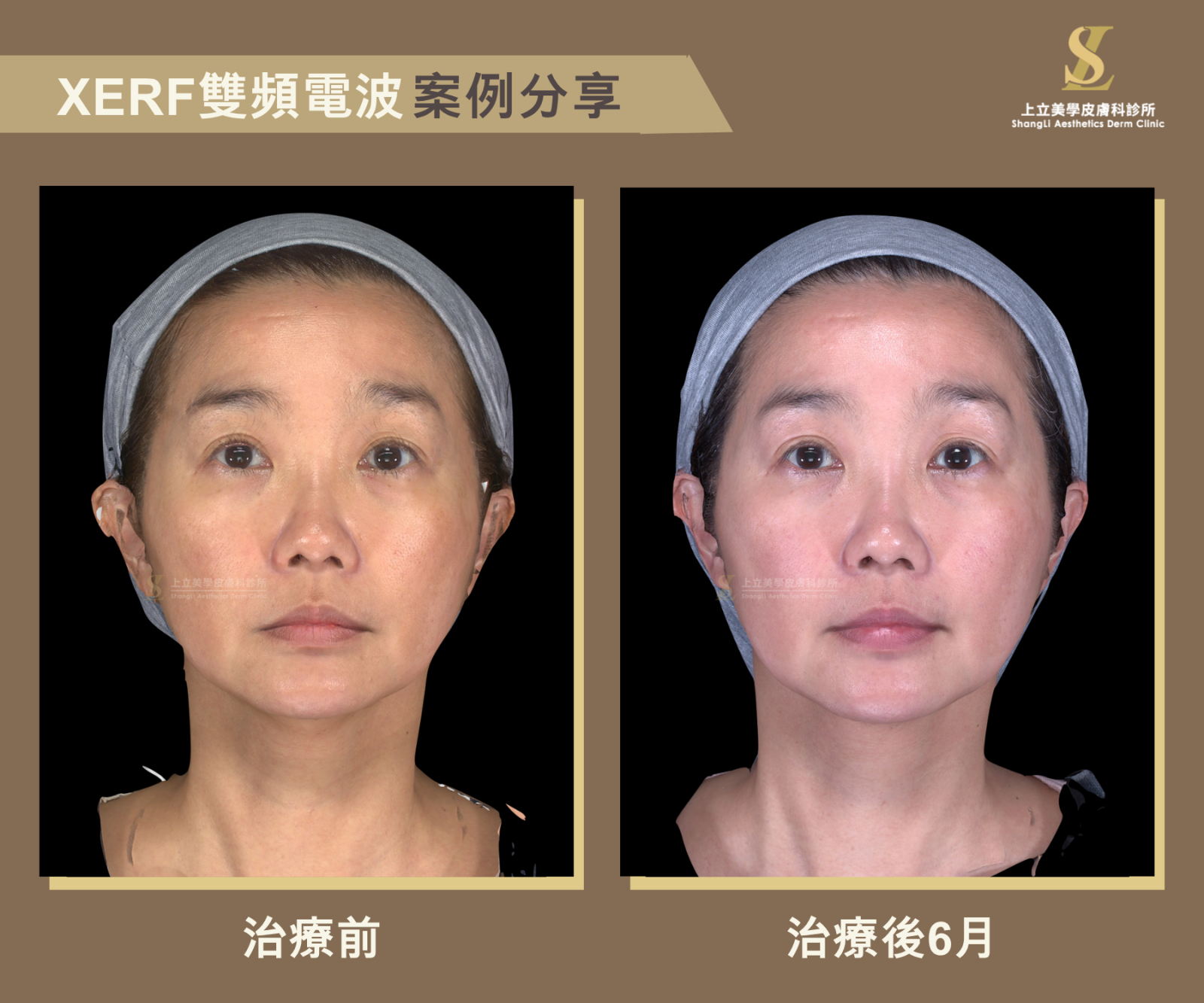 XERF雙頻電波透過不同深度模式的切換，卻能在大面積改善皮膚支撐性與緊實度的同時，不破壞到脂肪細胞，避免臉頰越打越凹。